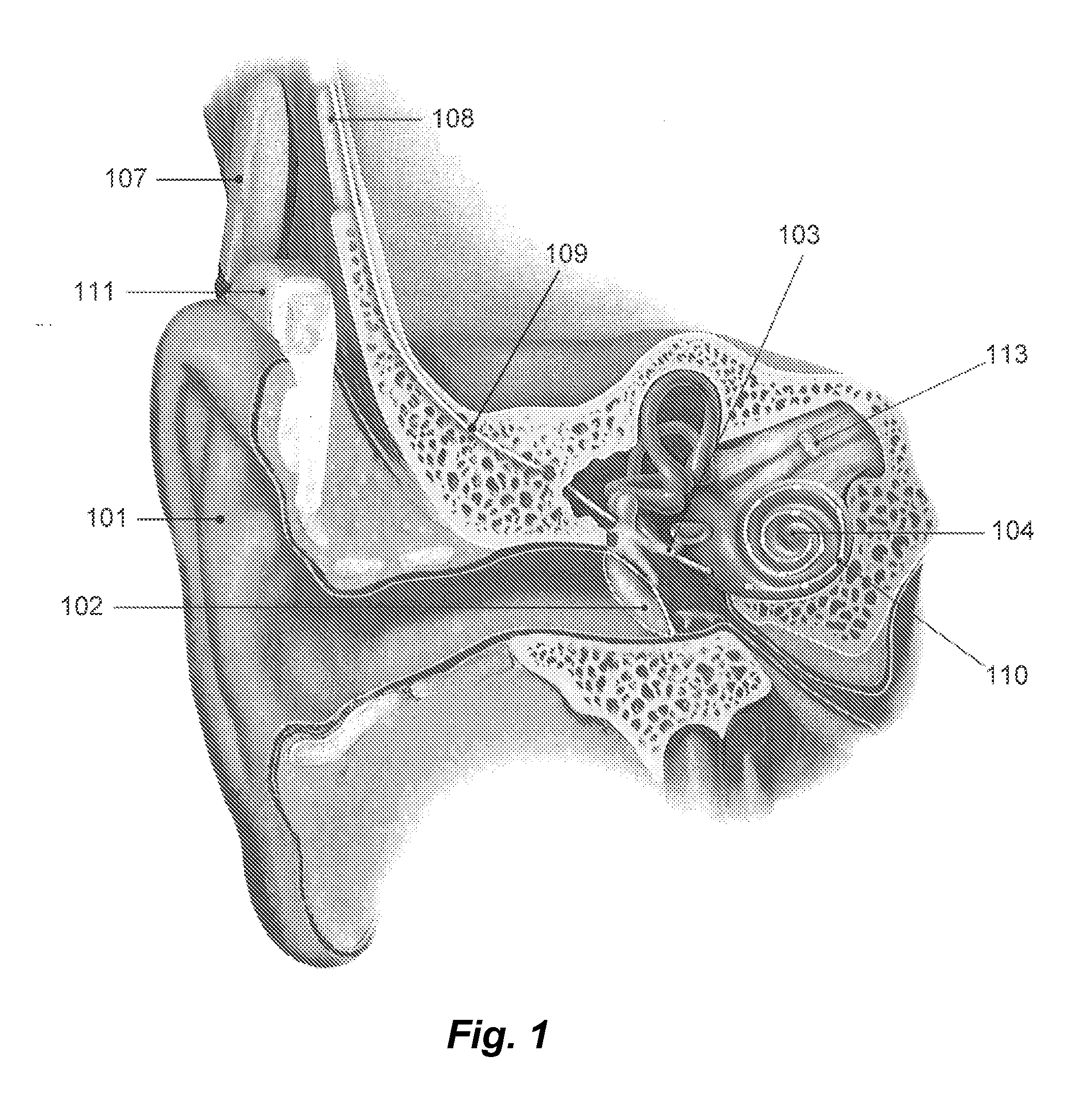 Method For Fitting A Cochlear Implant With Patient Feedback