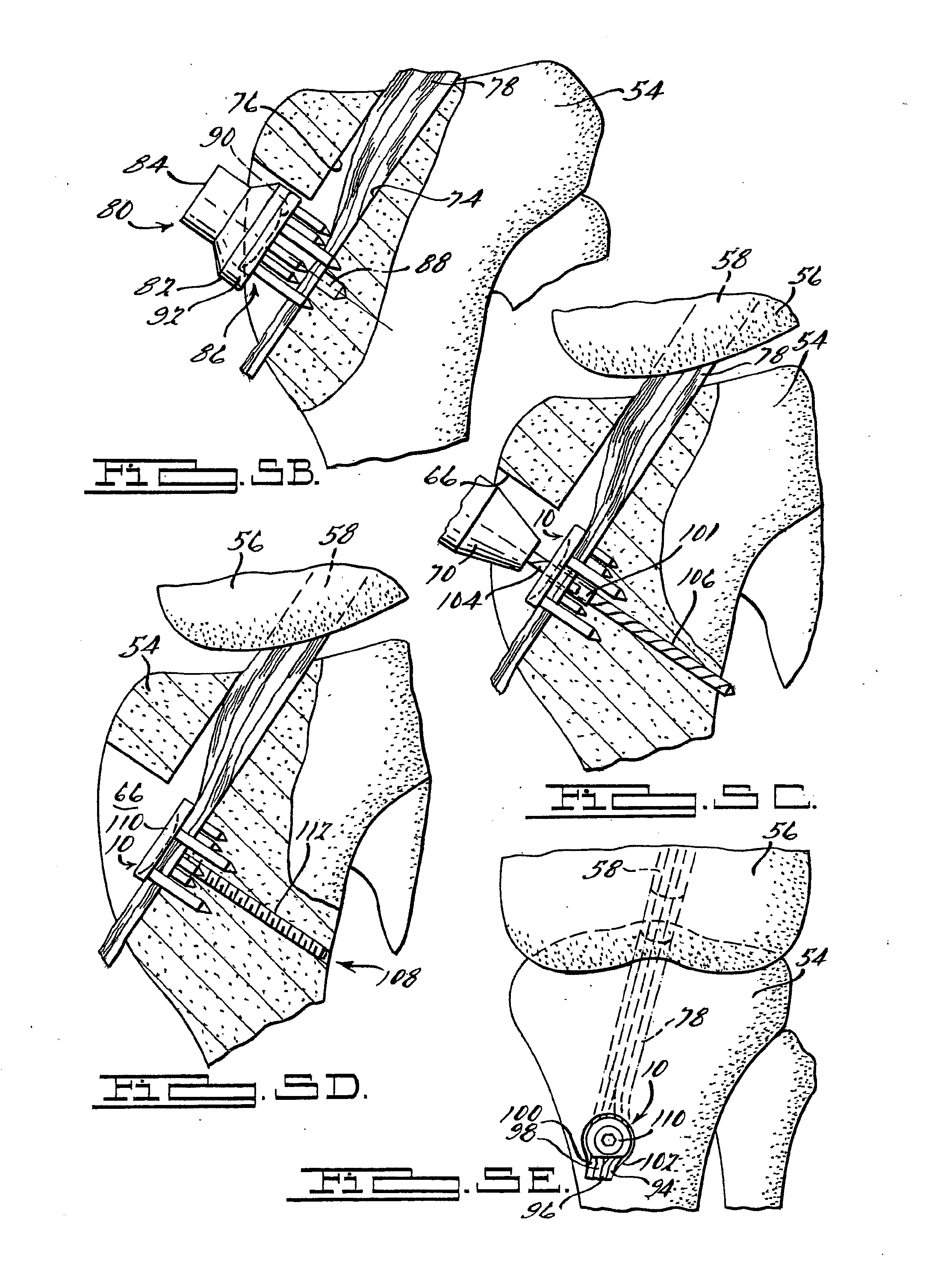 Apparatus and Method for Tibial Fixation of Soft Tissue