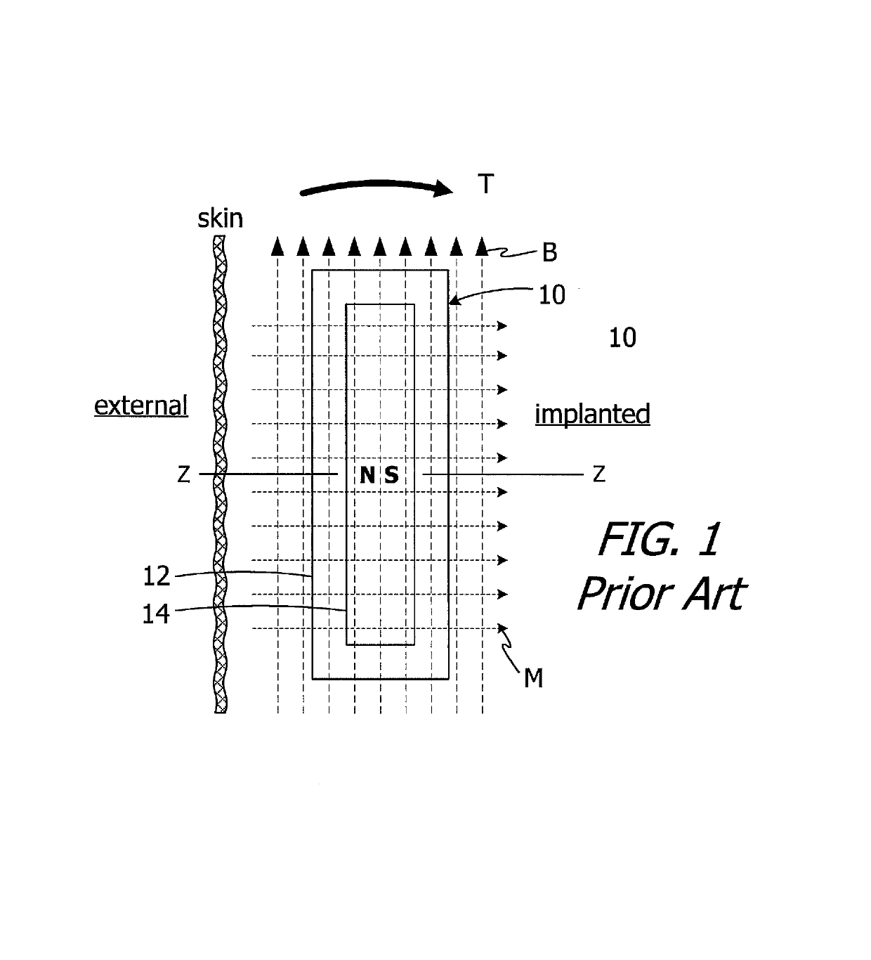 Cochlear implants having MRI-compatible magnet apparatus and associated methods