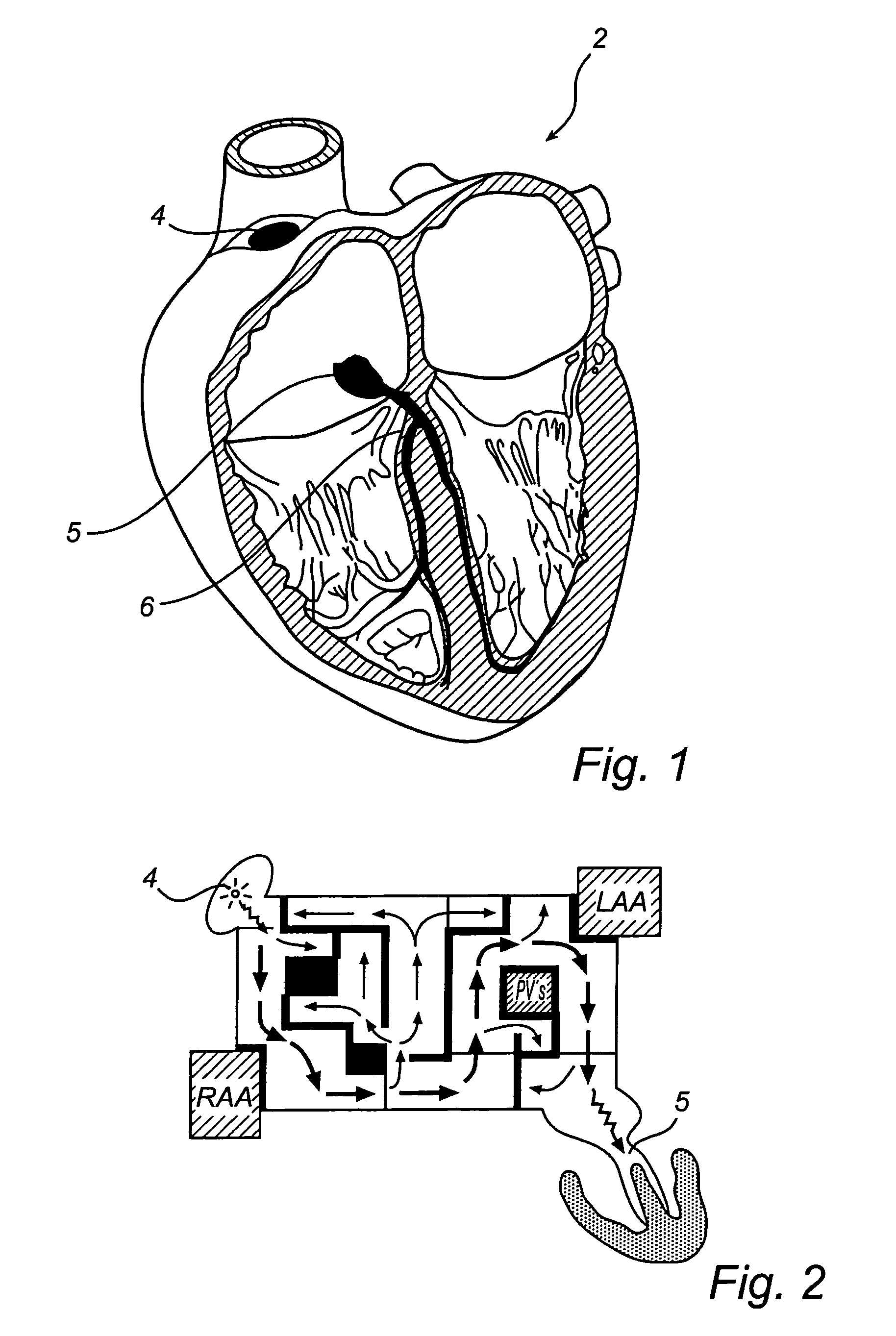 Device, a kit and a method for treatment of disorders in the heart rhythm regulation system