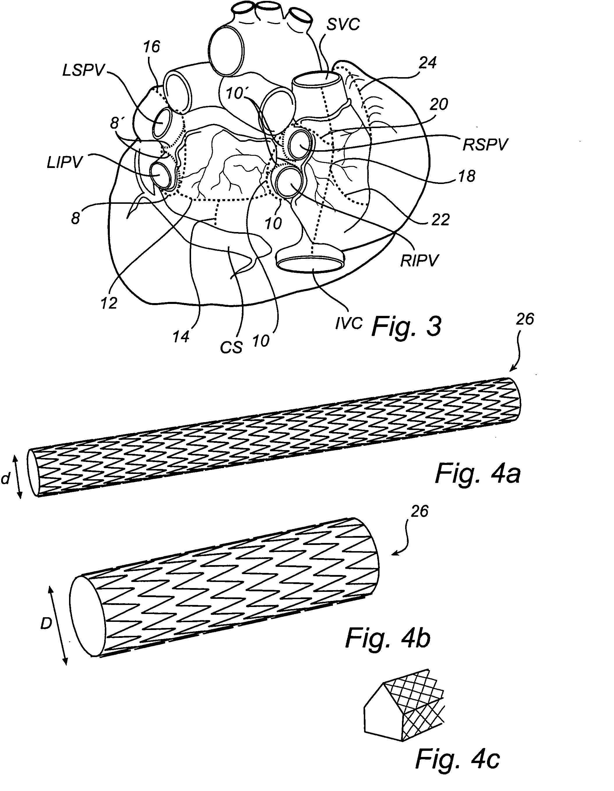 Device, a kit and a method for treatment of disorders in the heart rhythm regulation system