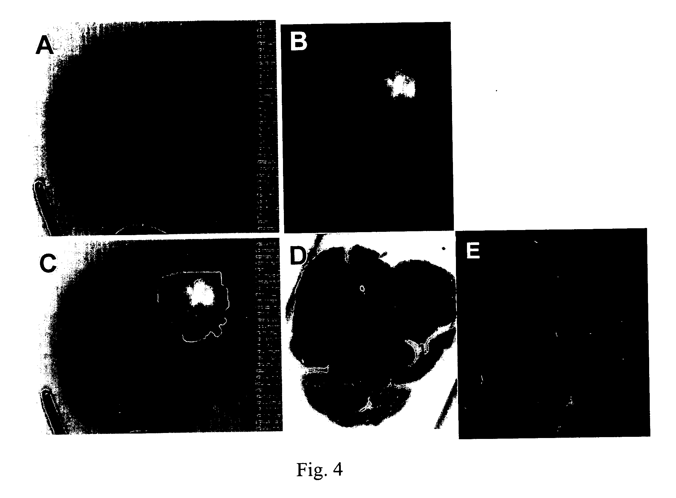 Methods of detecting breast cancer, brain cancer, and pancreatic cancer