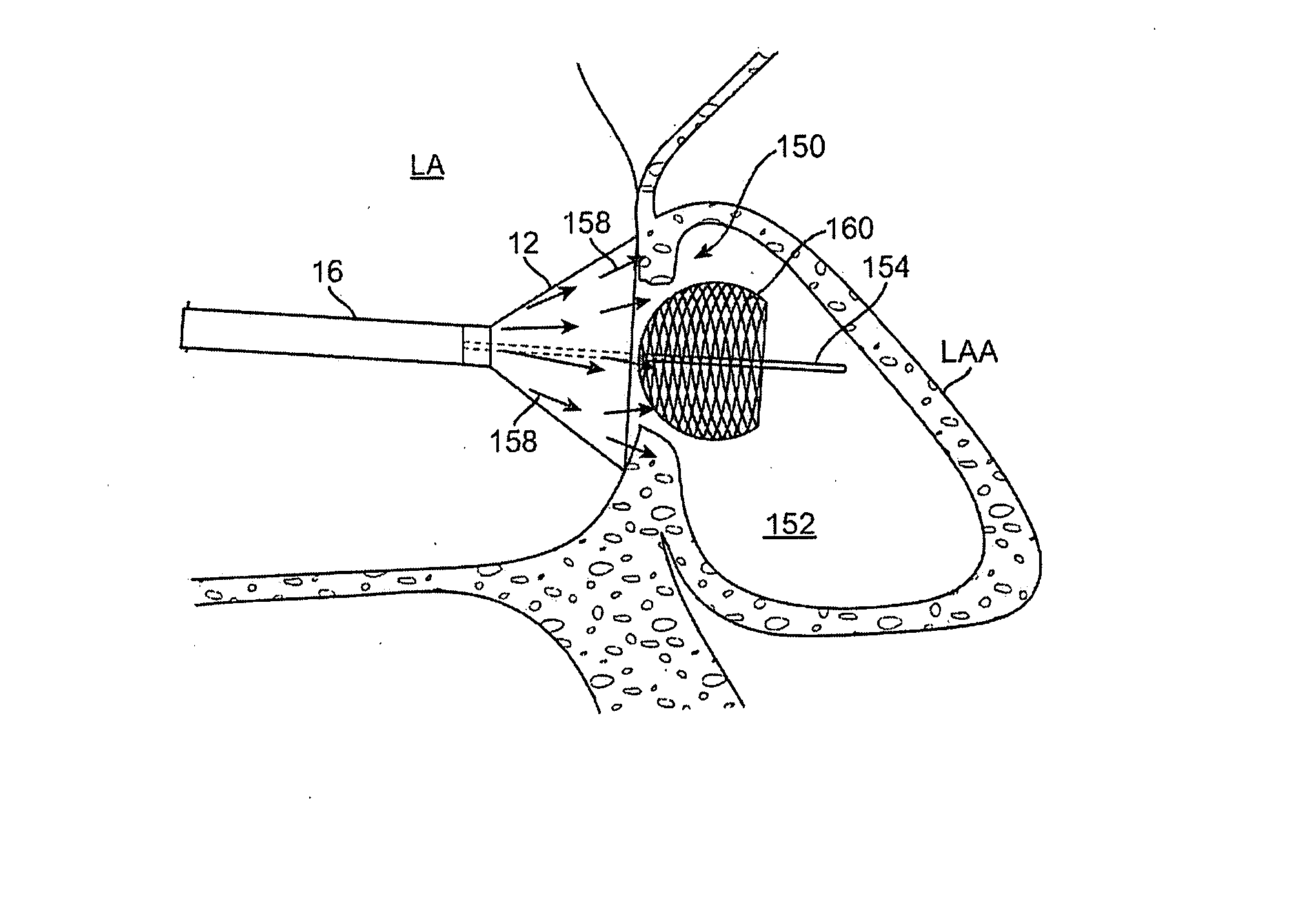 Left atrial appendage closure