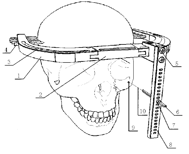 An adjustable midface bone distractor and its design method