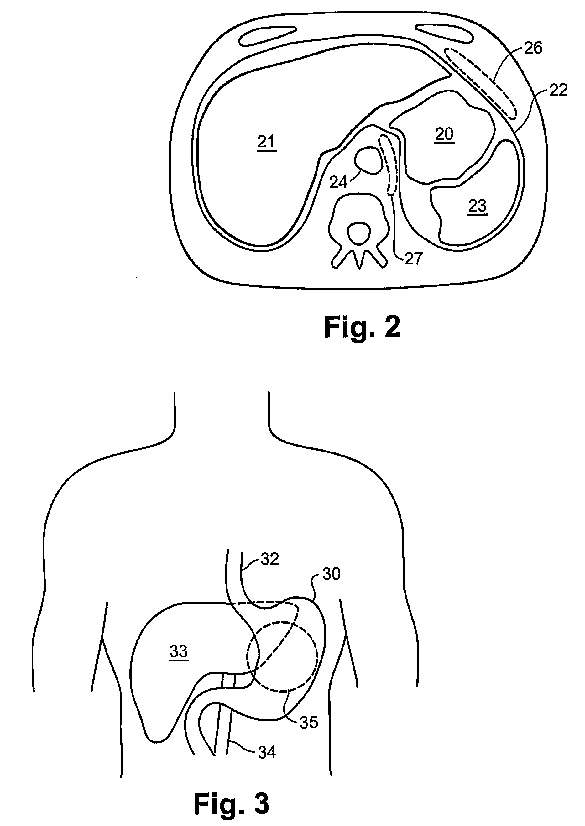 Implantable Device For Obesity Prevention