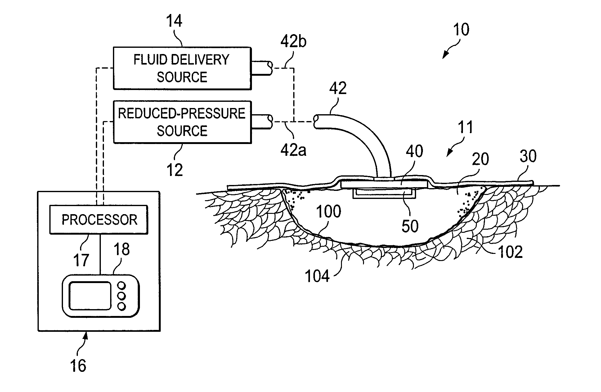 System and method for treating a wound using ultrasonic debridement