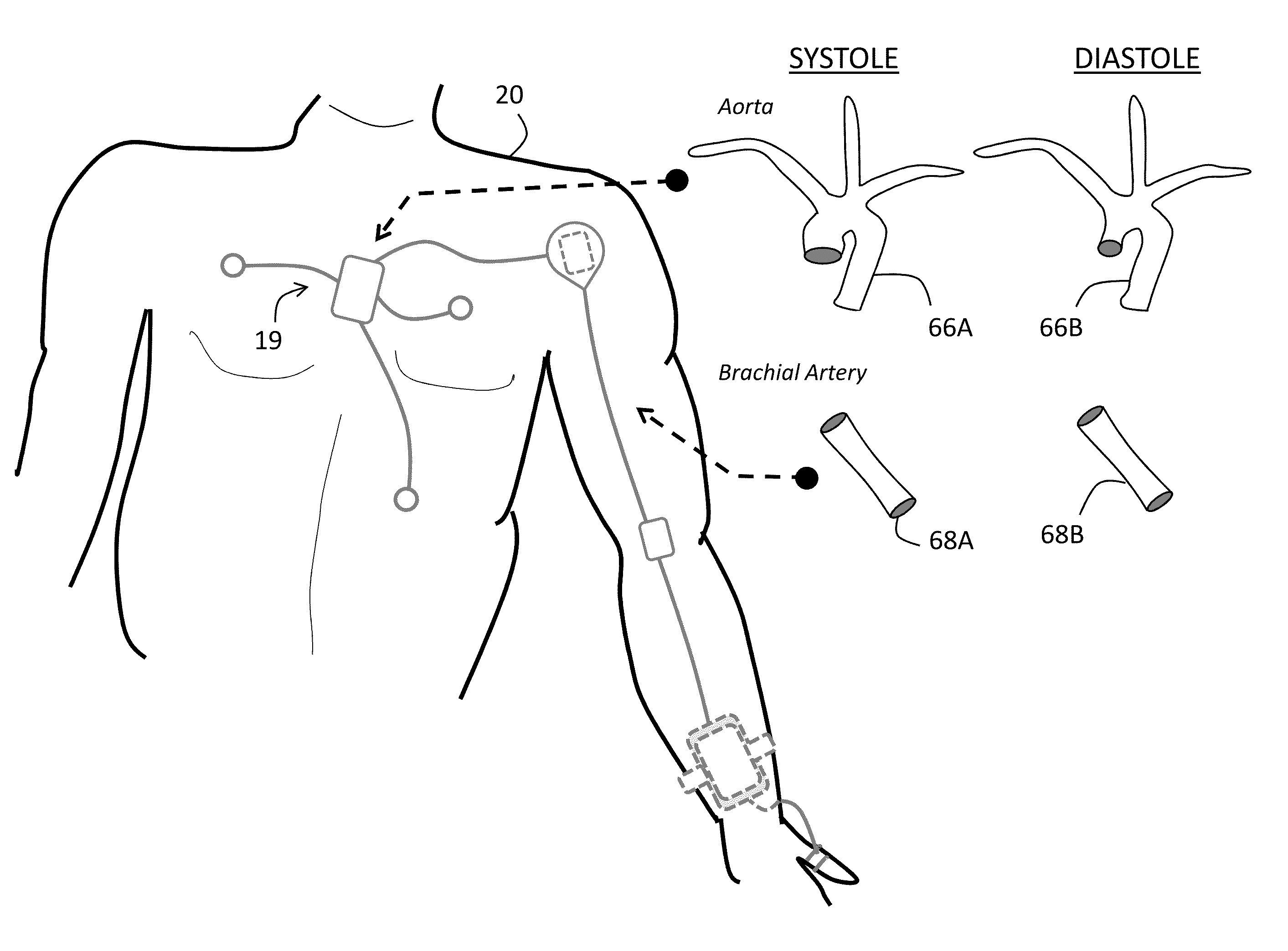 Body-worn system for continuous, noninvasive measurement of cardiac output, stroke volume, cardiac power, and blood pressure