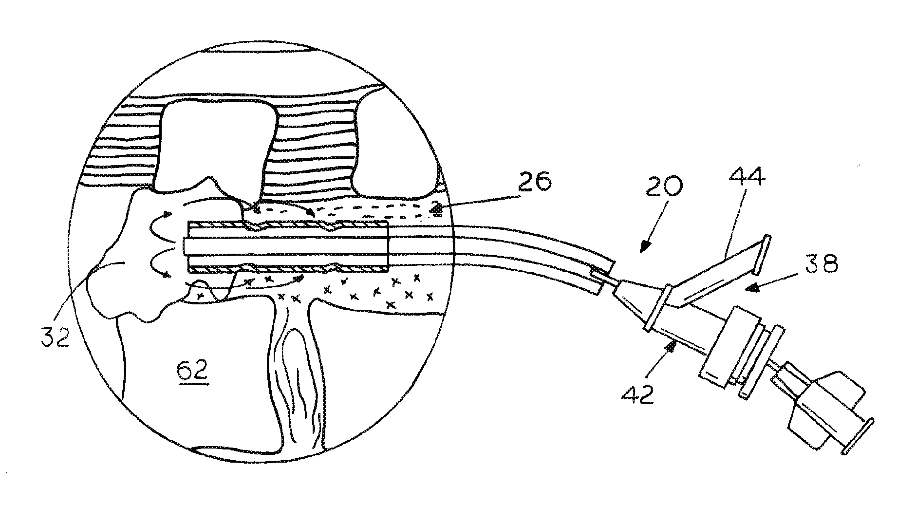 Extradural Infusion Suction System and Method to Drain Fluid Collection in the Extradural Space of Spinal Cord