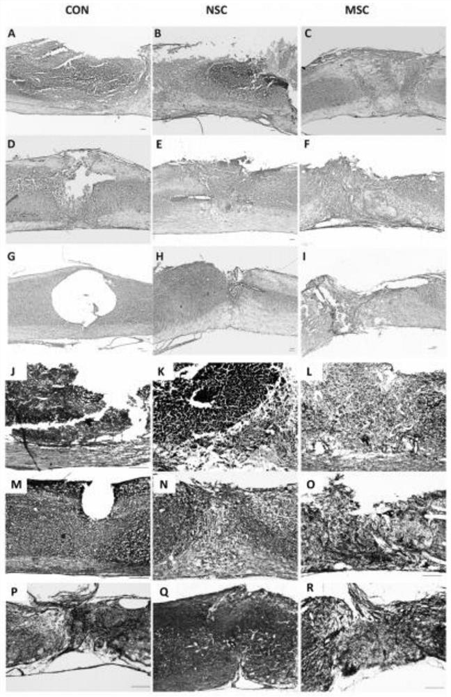 Application of neural stem cells combined with umbilical cord mesenchymal stem cells in spinal cord injury