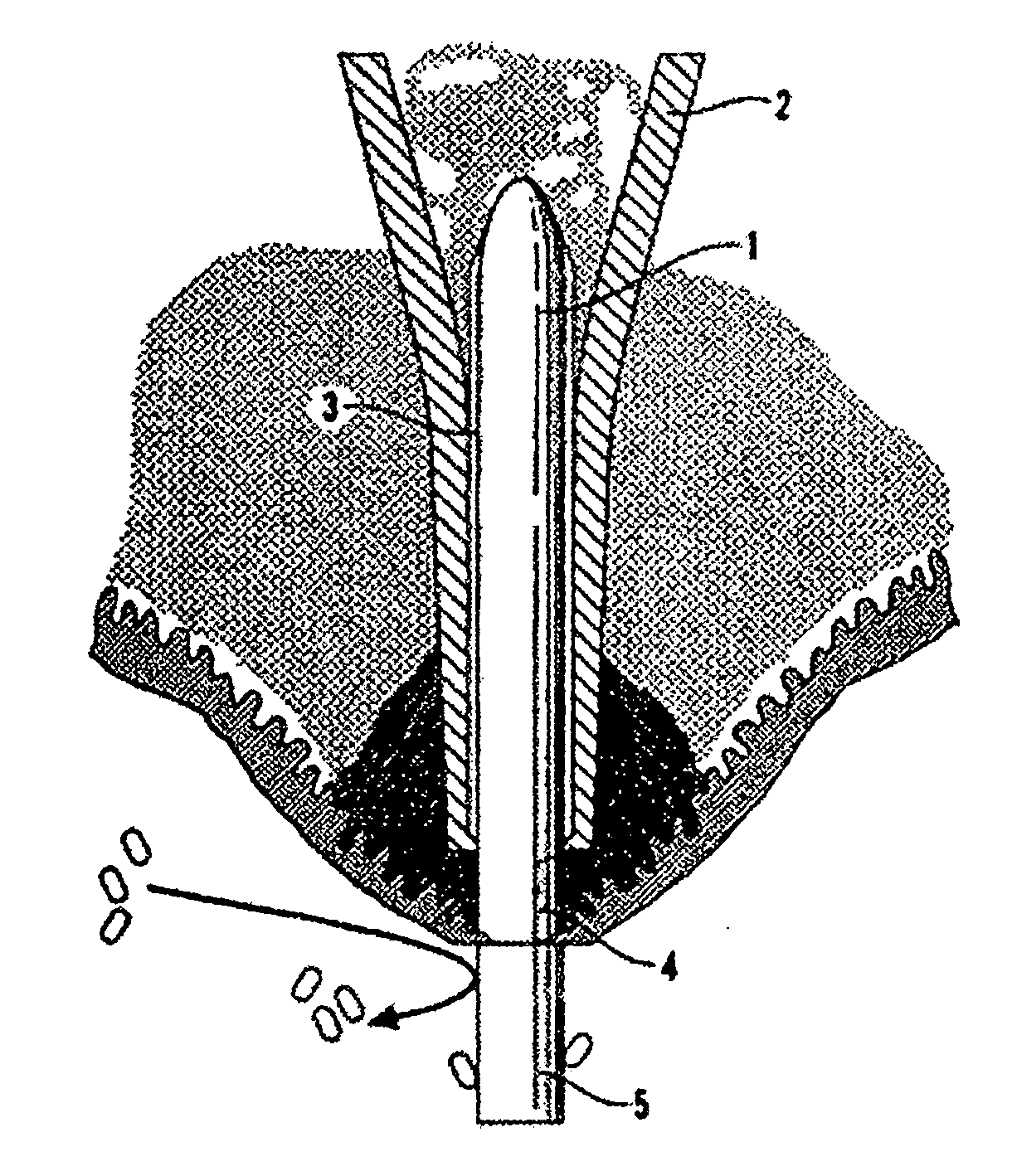 Transcutaneous Prosthesis