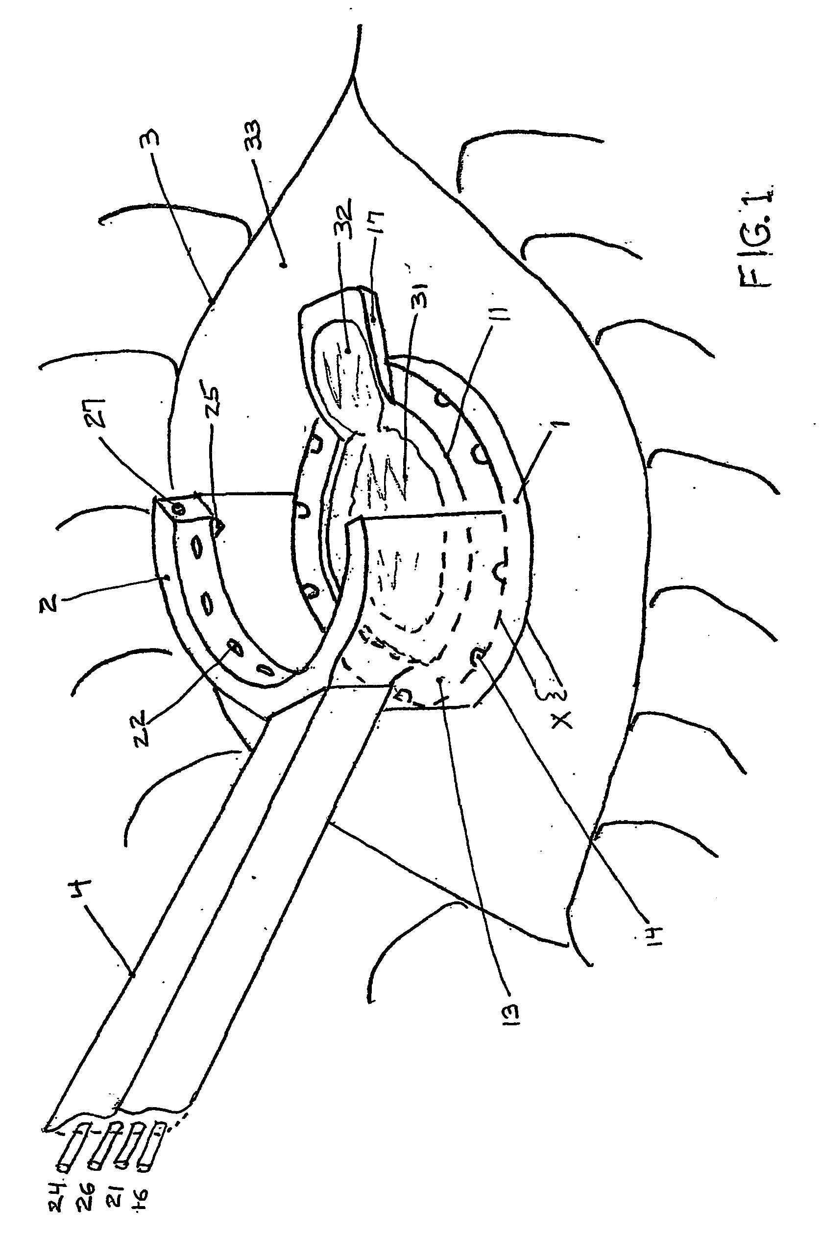 Multi-function surgical instrument for facilitating opthalmic laser surgery