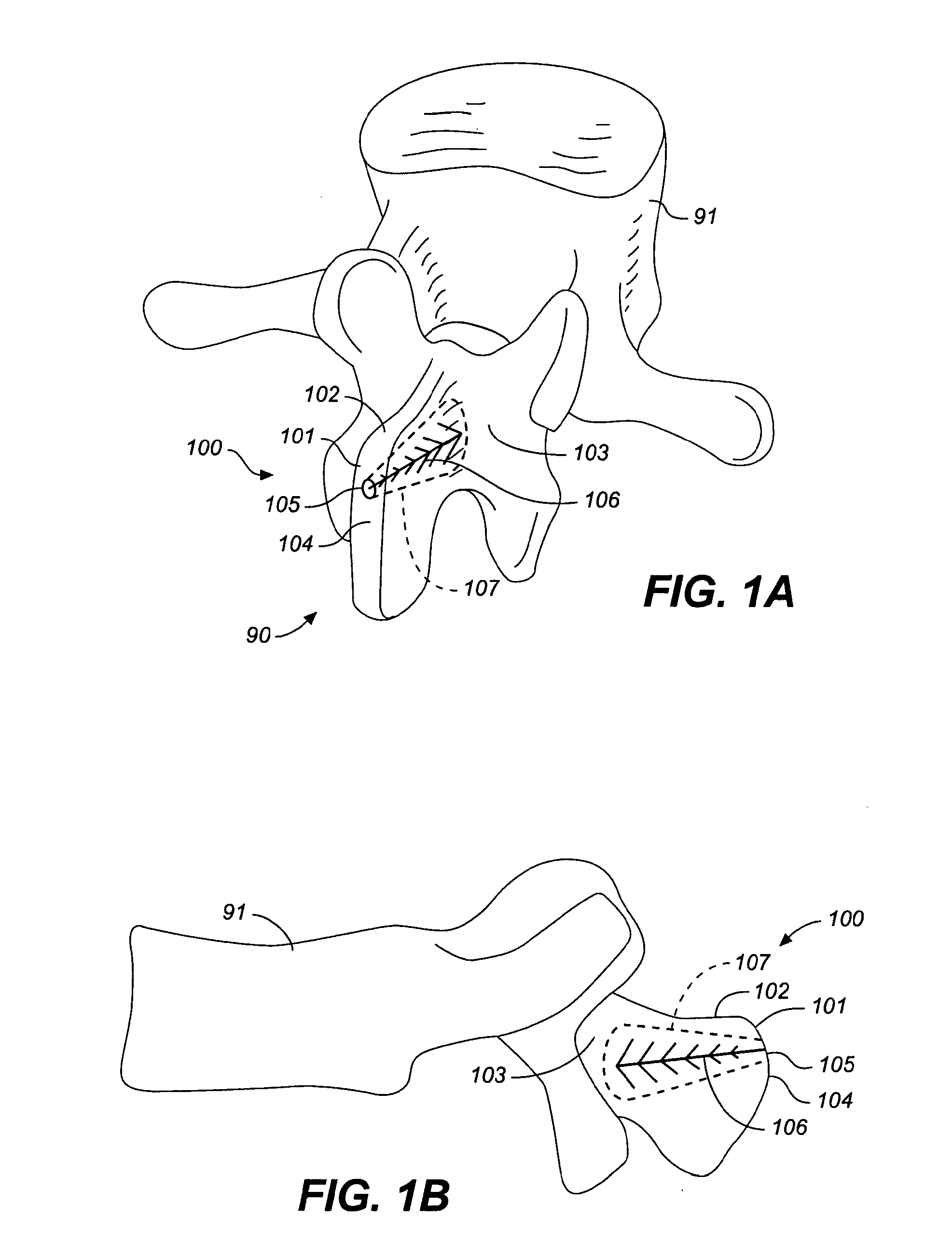 Adjustable spinal implant device and method