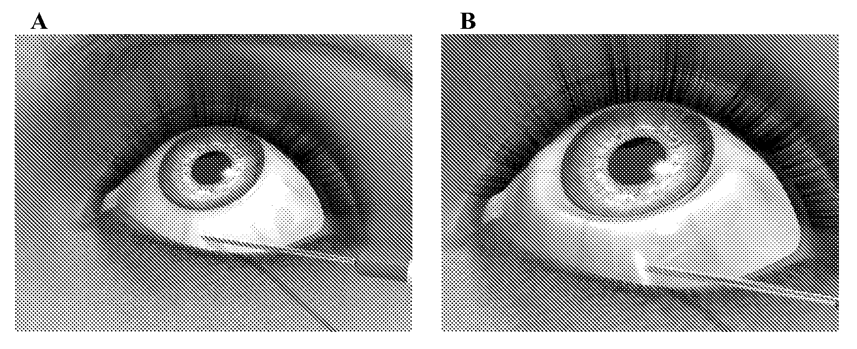 Method for Treating Primary and Secondary Forms of Glaucoma