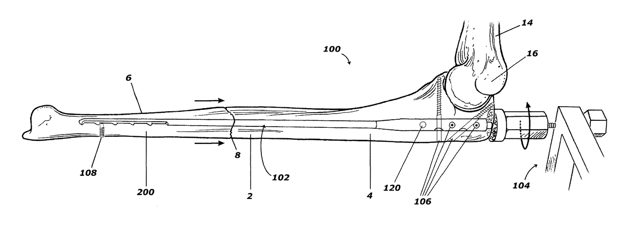 Intramedullary compression rod