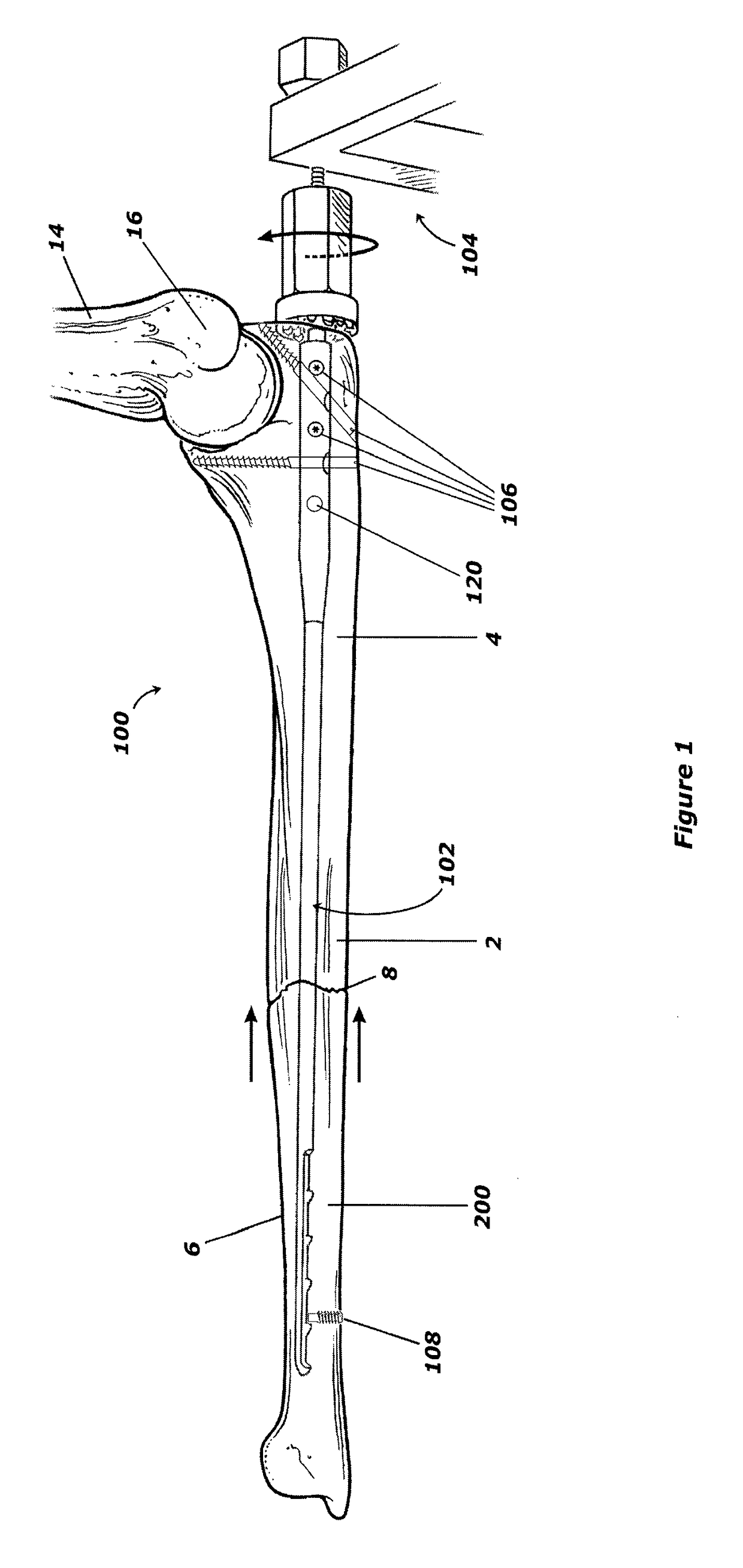 Intramedullary compression rod