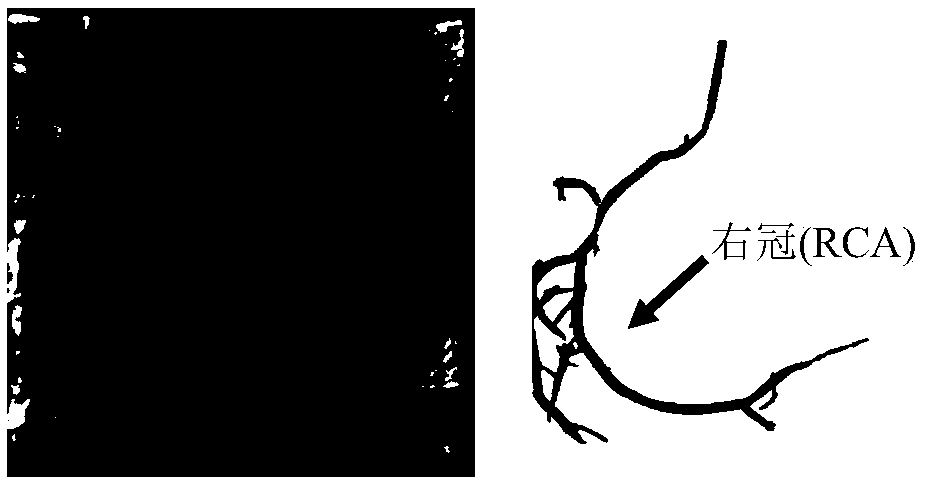 Blood flow speed calculation method for coronary artery based on radiography image