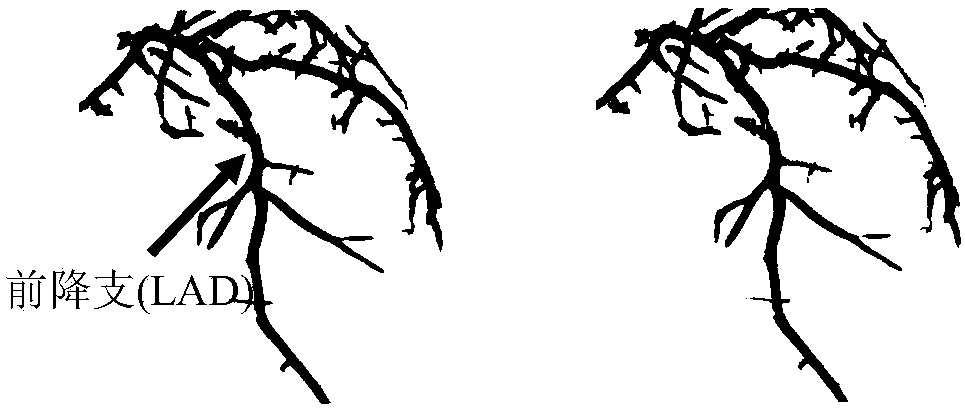 Blood flow speed calculation method for coronary artery based on radiography image