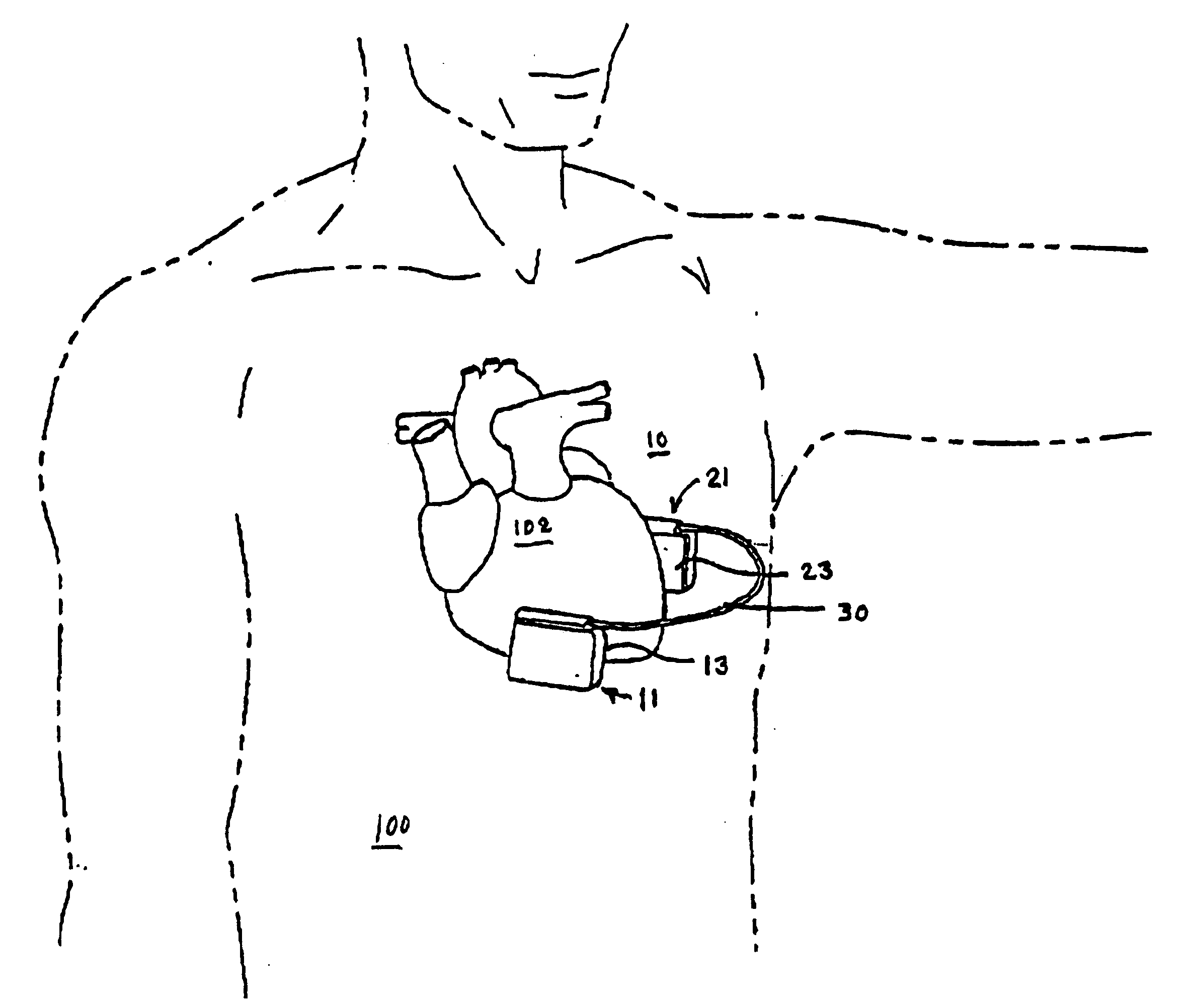 Subcutaneous implantable cardioverter/defibrillator