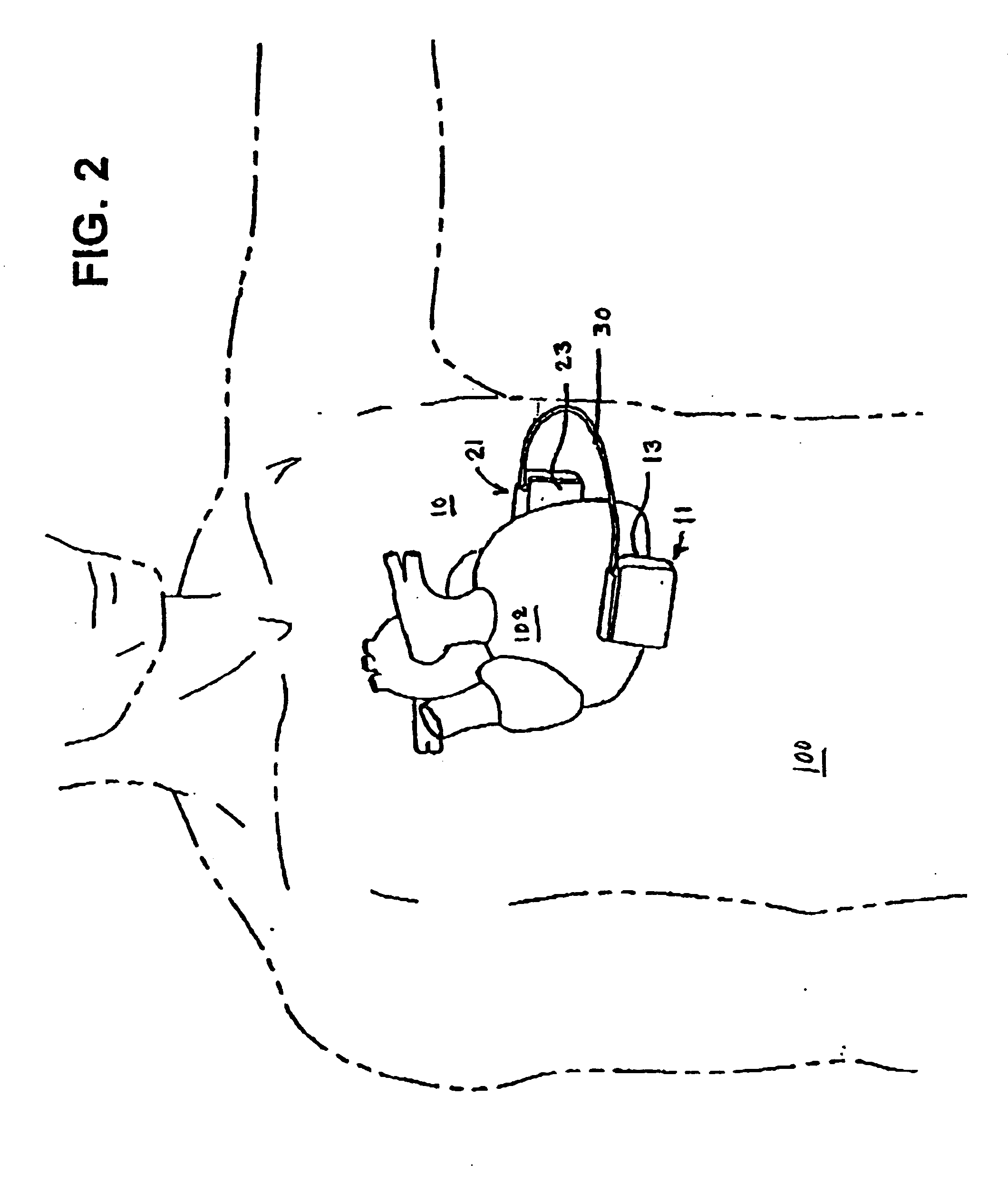 Subcutaneous implantable cardioverter/defibrillator