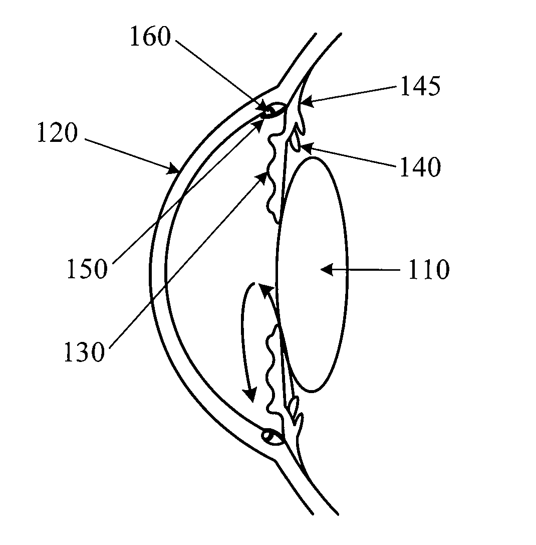 Application of an Electrical Field in the Vicinity of the Trabecular Meshwork to Treat Glaucoma