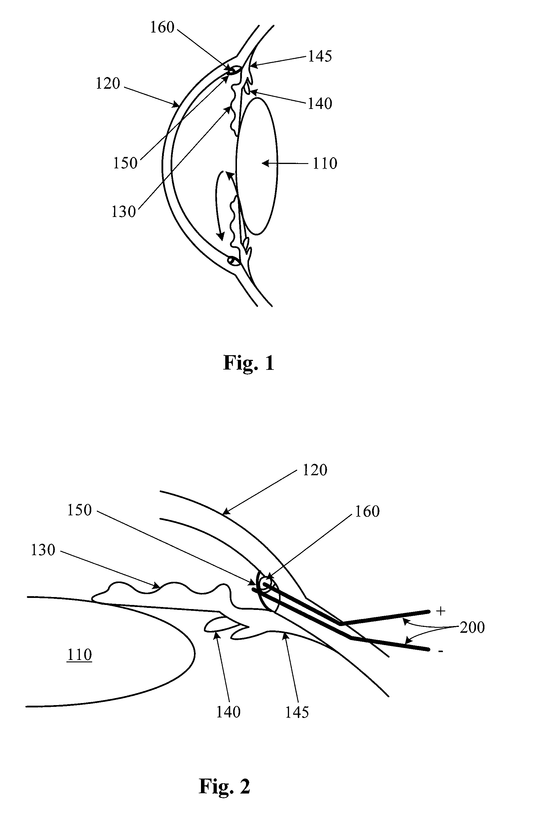 Application of an Electrical Field in the Vicinity of the Trabecular Meshwork to Treat Glaucoma