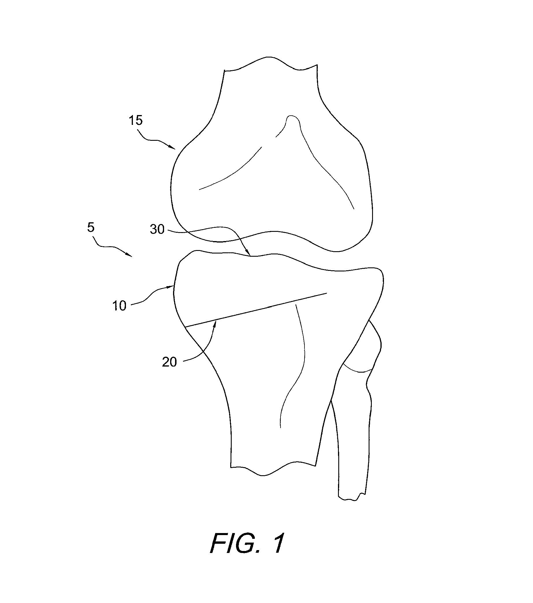 Method for performing an open wedge, high tibial osteotomy