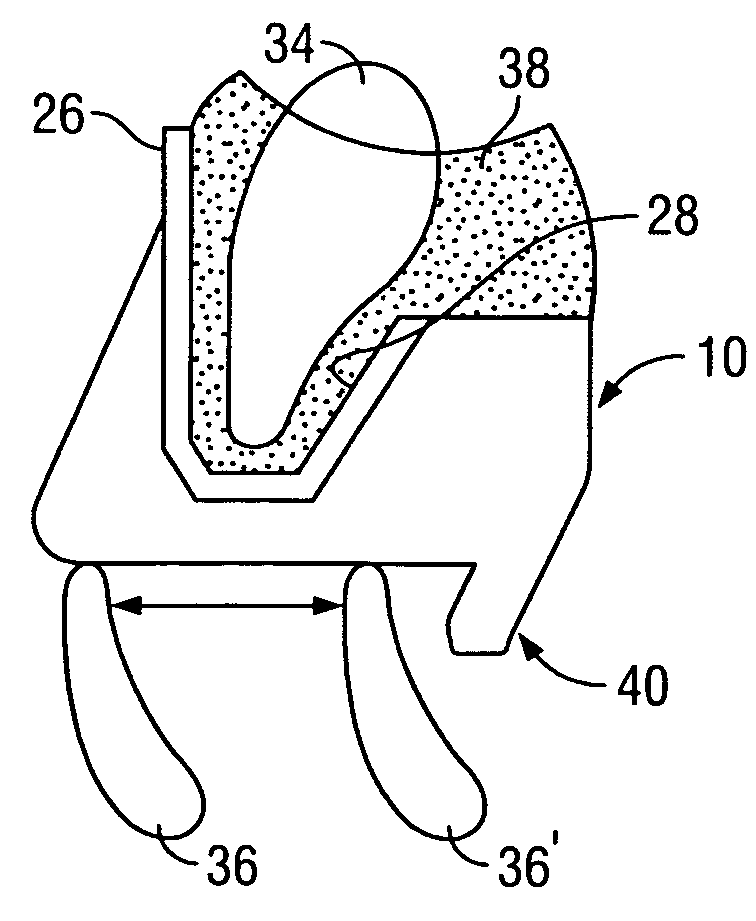 Intraoral discluder and method for relieving migraine and tension headaches and temporomandibular disorders