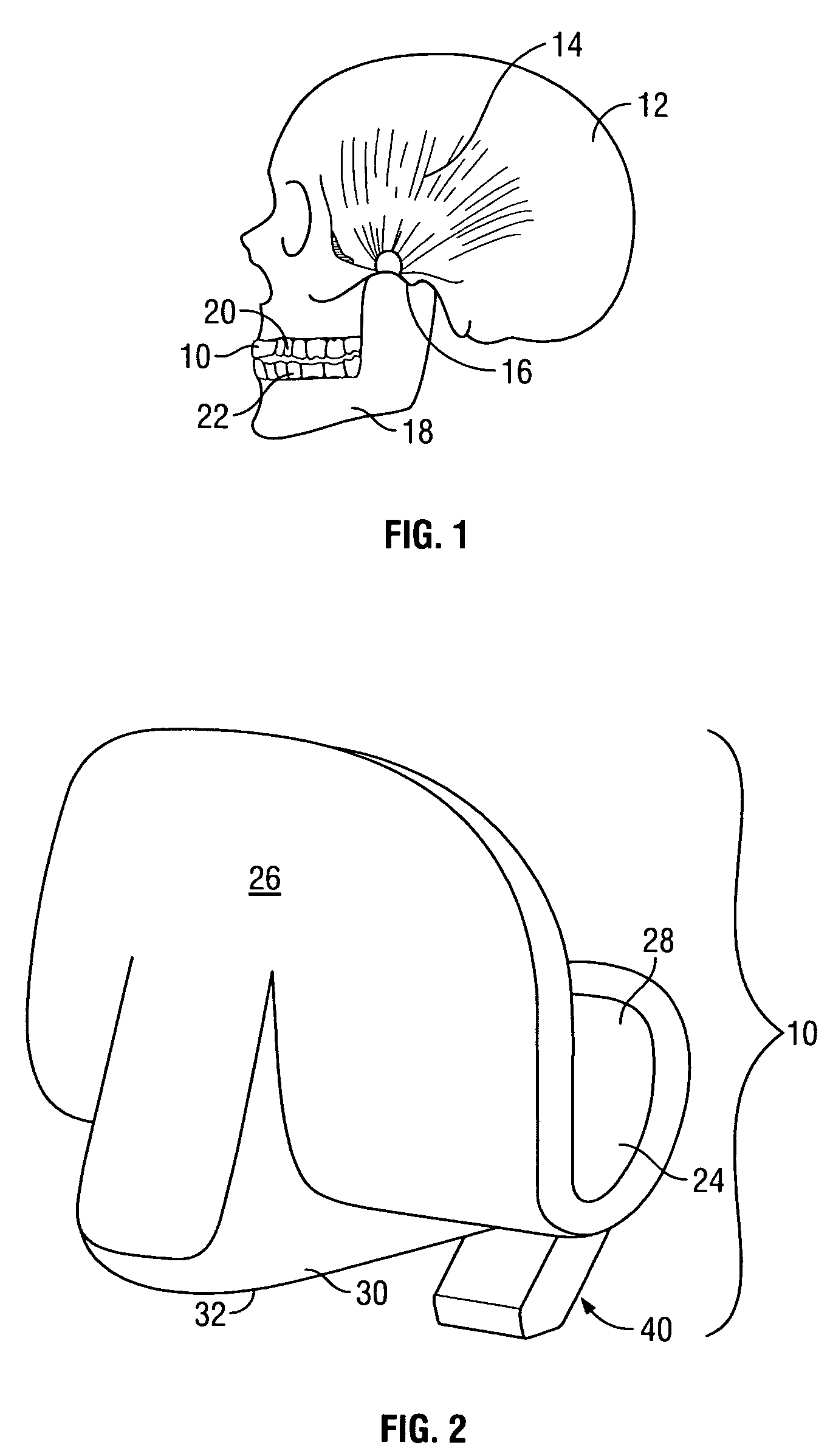 Intraoral discluder and method for relieving migraine and tension headaches and temporomandibular disorders