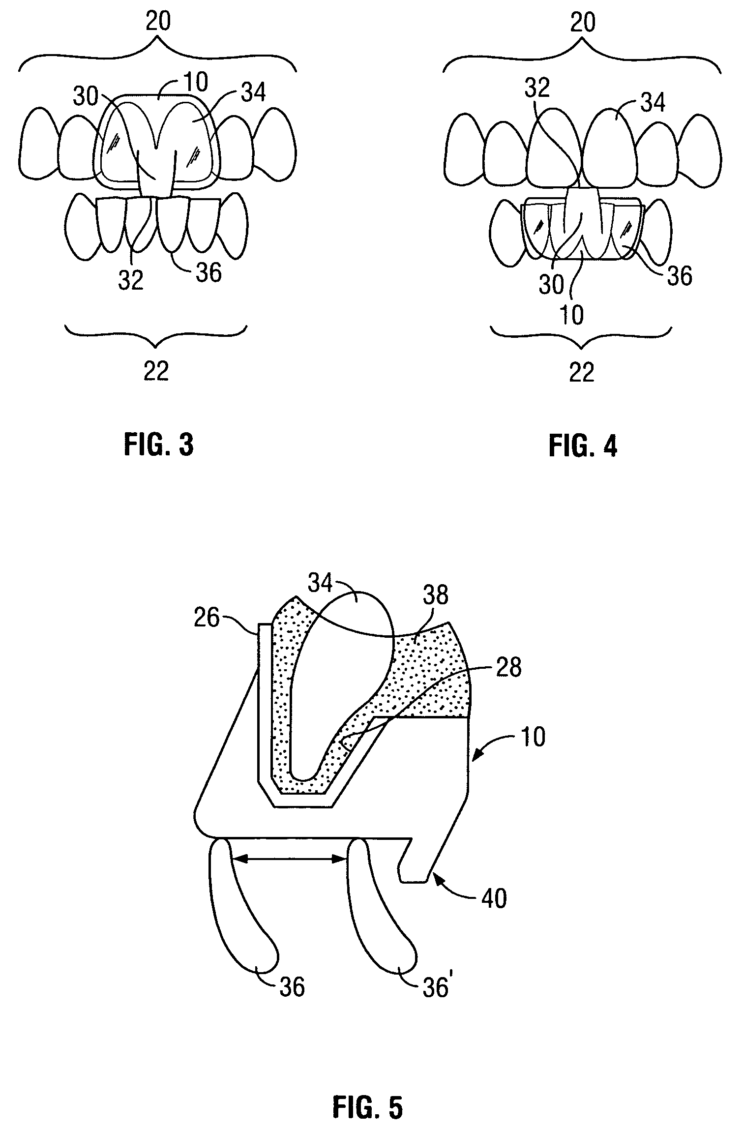 Intraoral discluder and method for relieving migraine and tension headaches and temporomandibular disorders