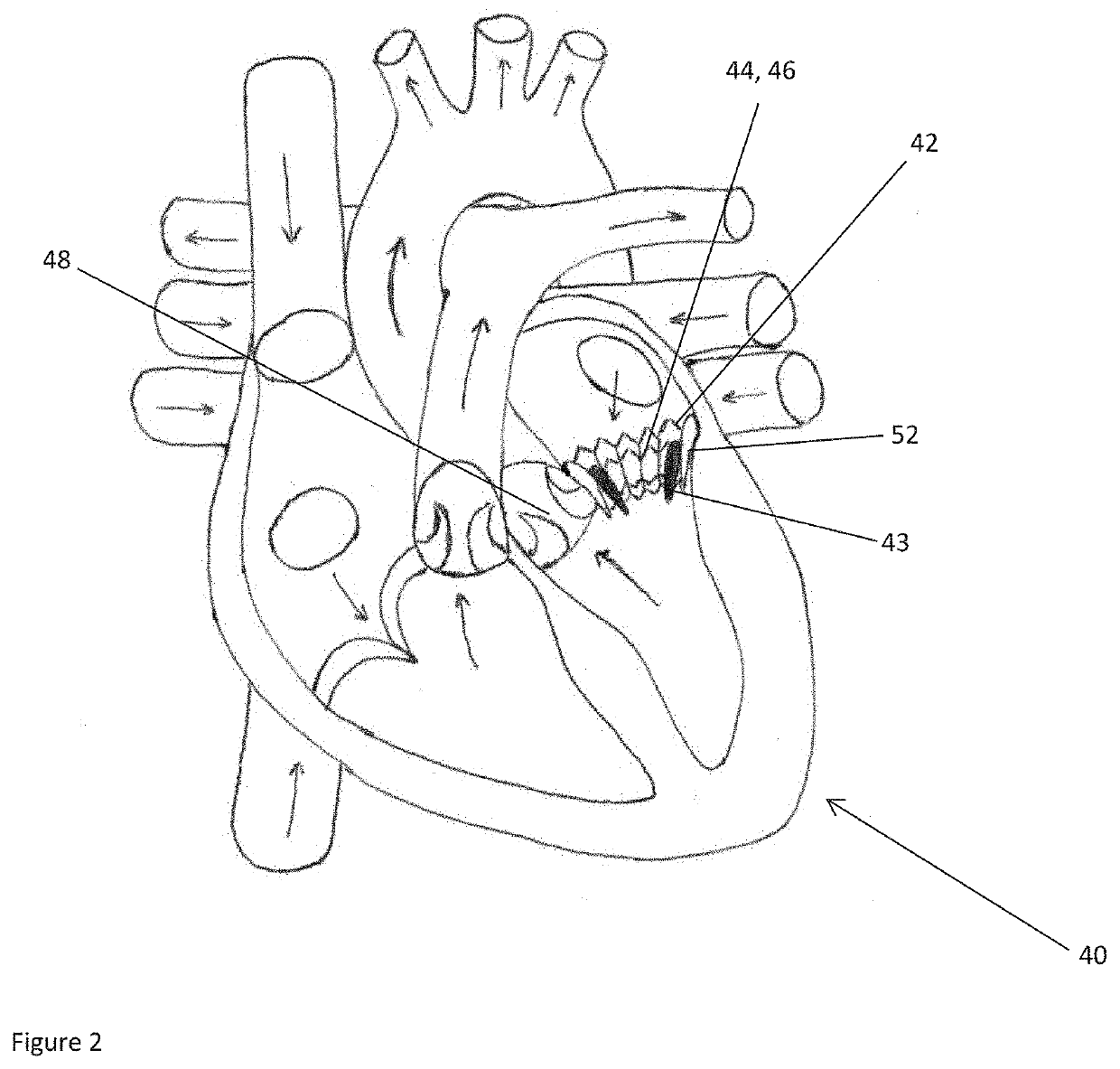 Method and System for Determining a Risk of Hemodynamic Compromise After Cardiac Intervention