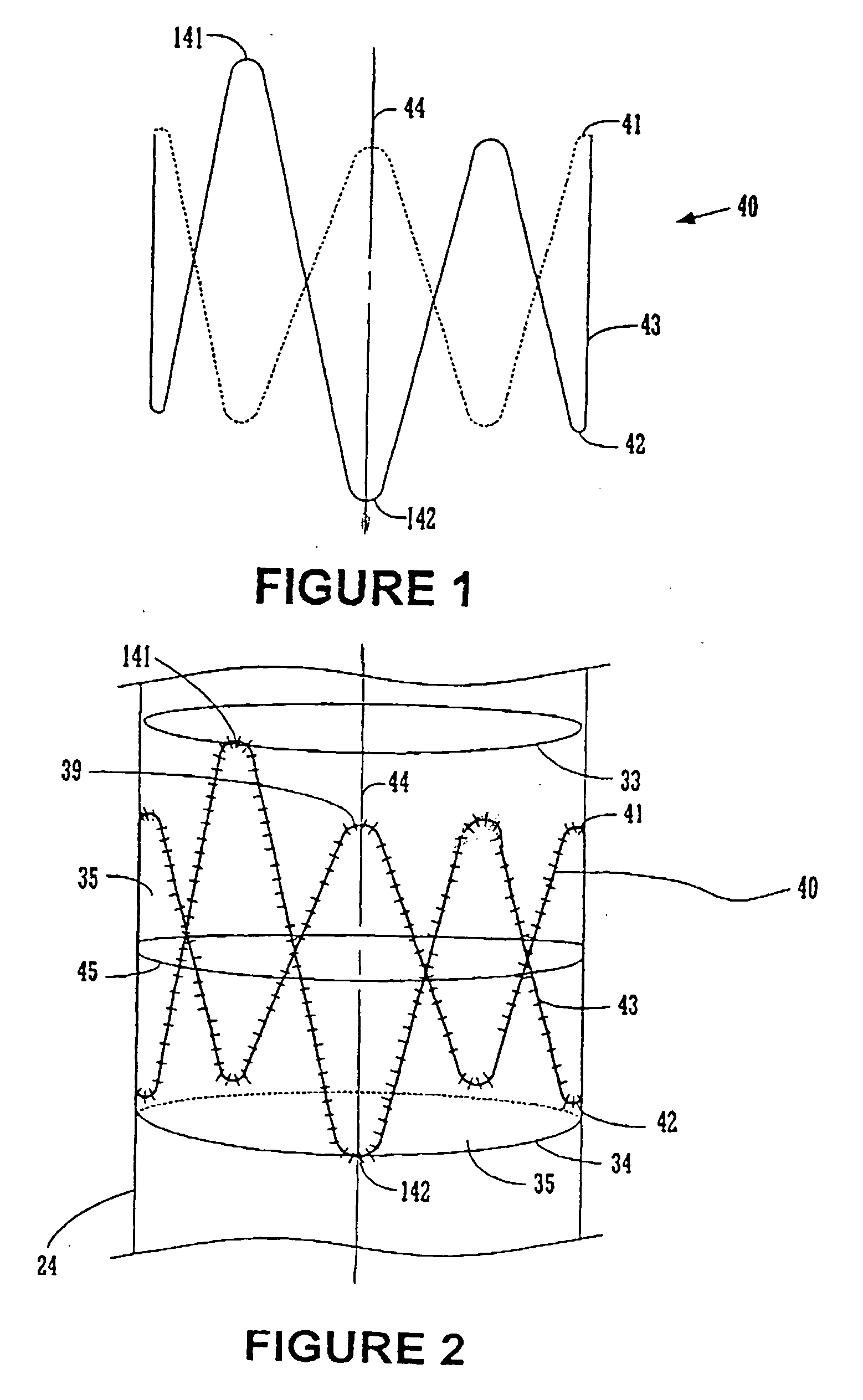 Endoluminal prosthesis