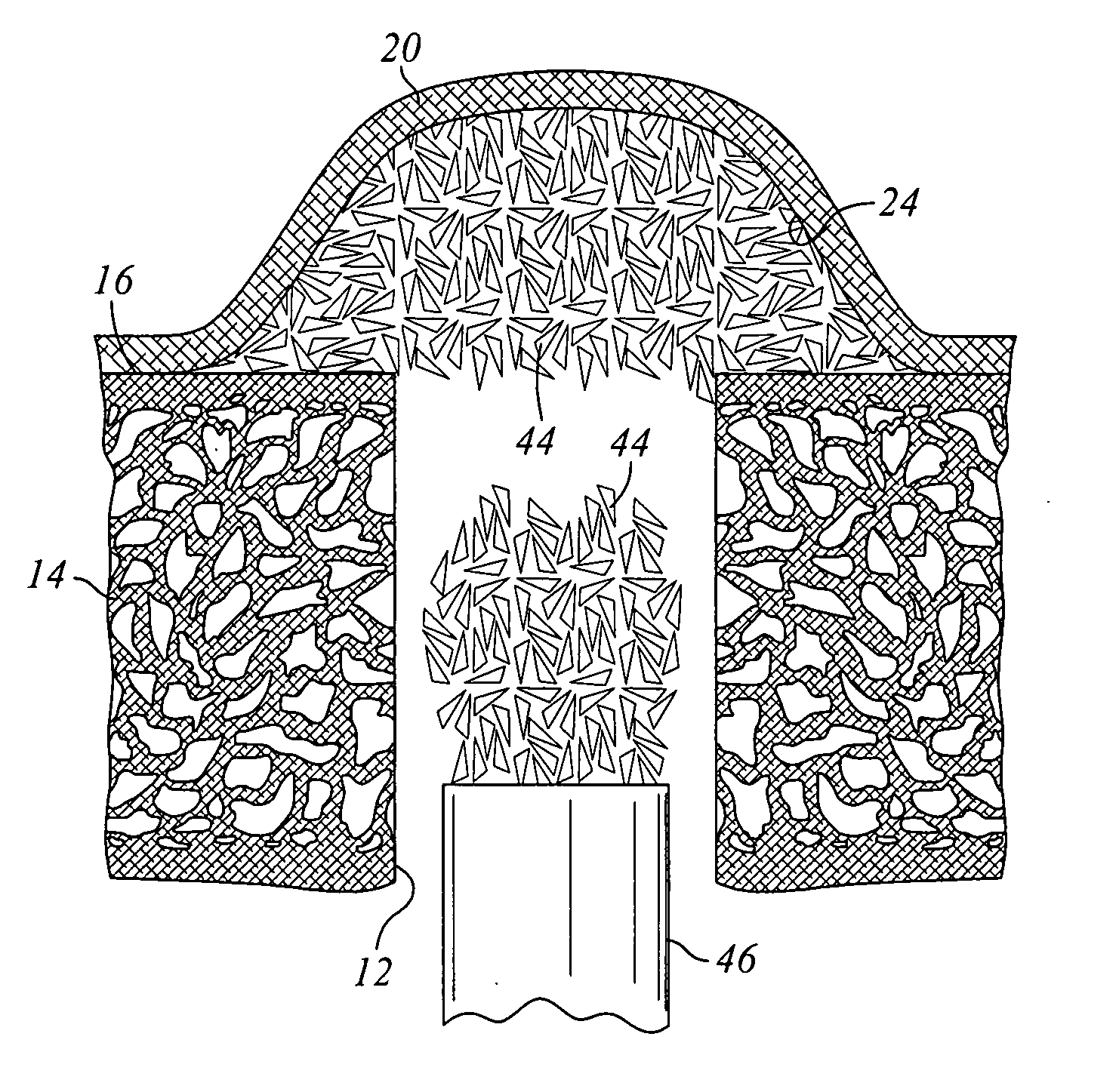 Internal sinus manipulation (ISM) procedure for facilitating sinus floor augmentation in dental procedures