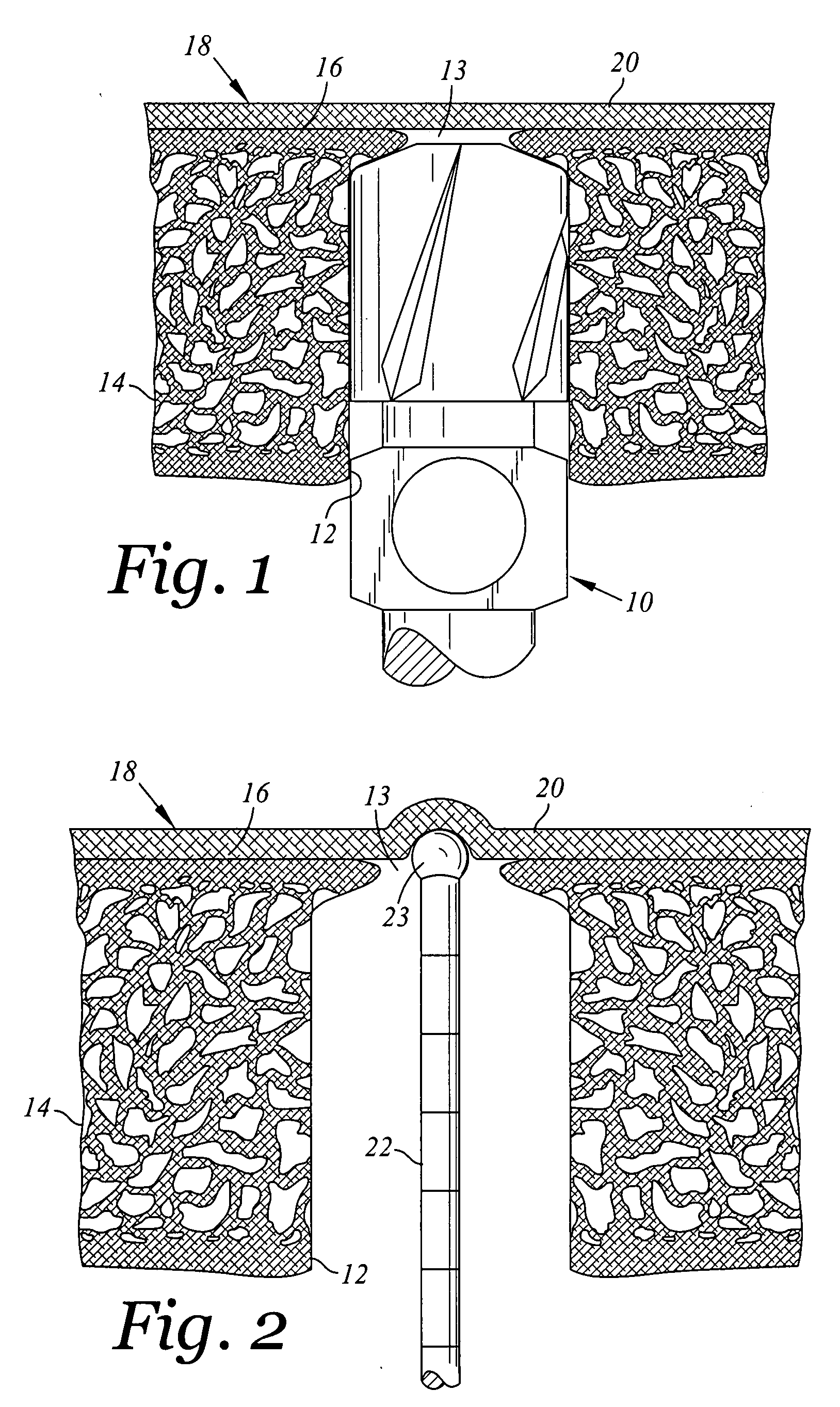 Internal sinus manipulation (ISM) procedure for facilitating sinus floor augmentation in dental procedures