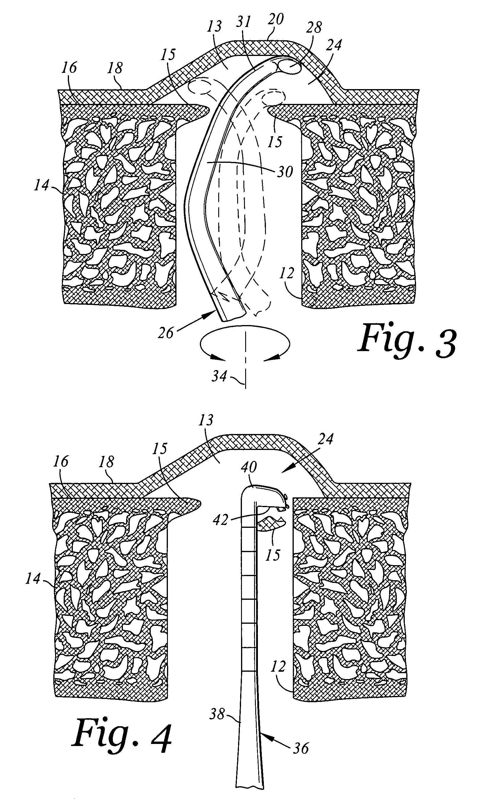 Internal sinus manipulation (ISM) procedure for facilitating sinus floor augmentation in dental procedures