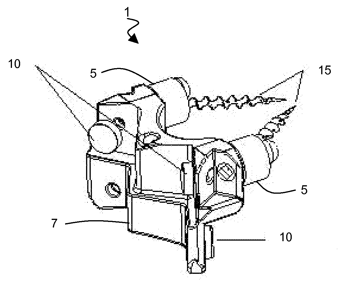 Prostheses for Spine Facets