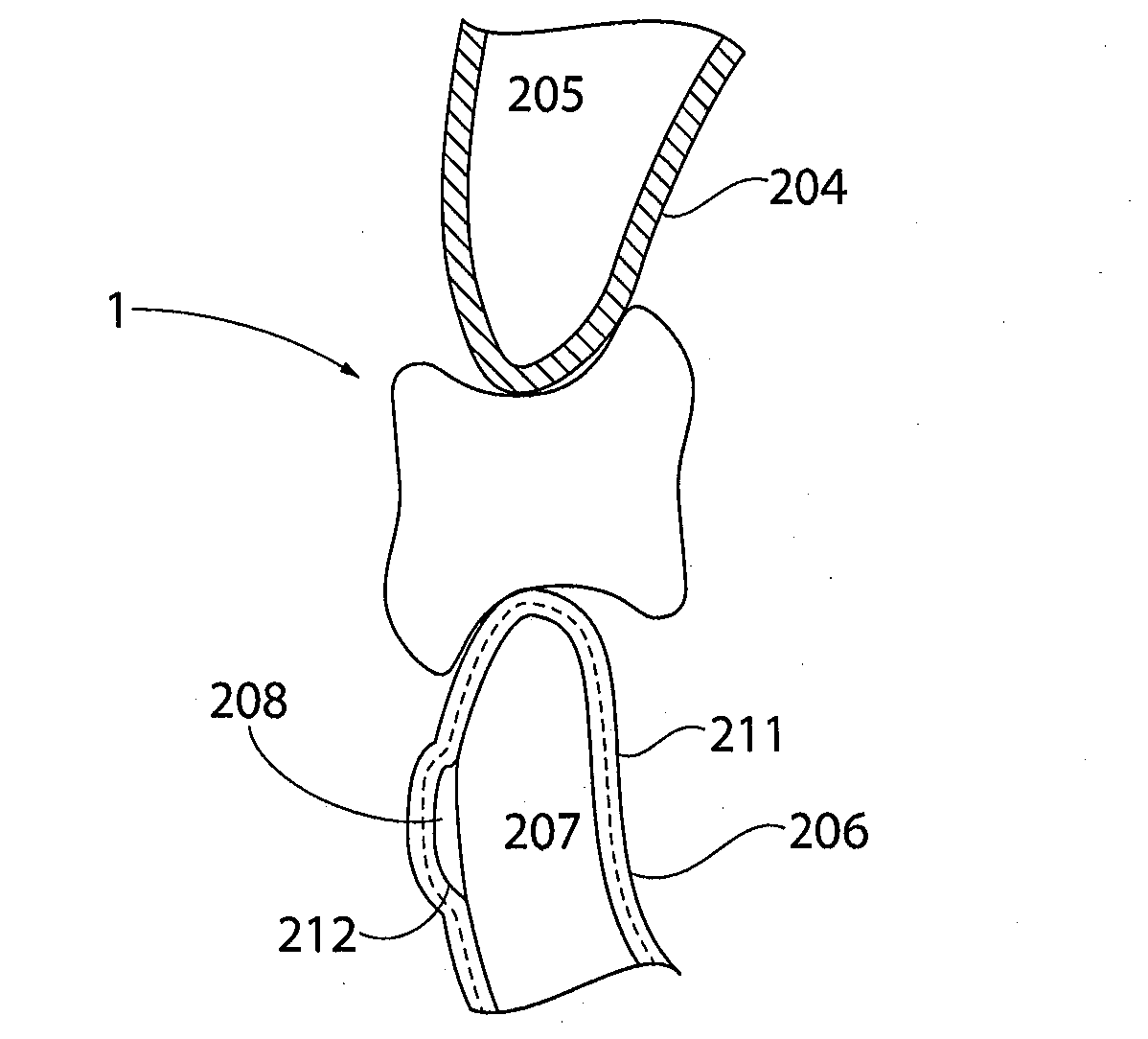 Therapeutically Countoured, Compliance Encouraging Aligner Implement