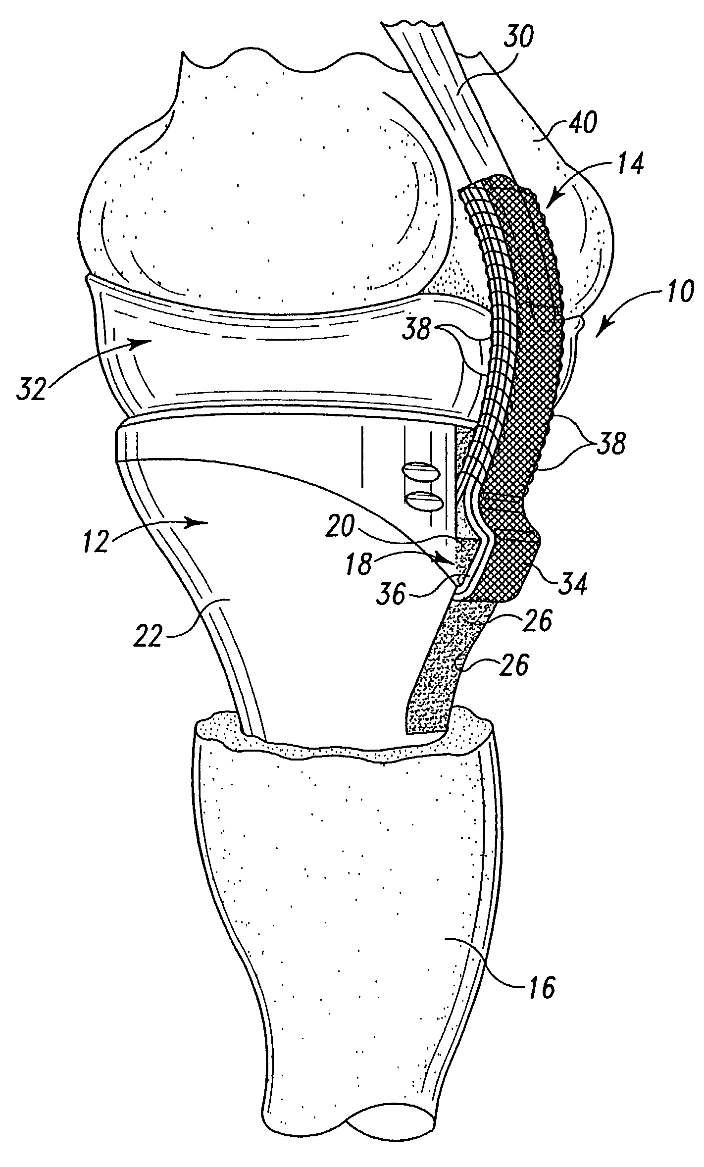 Method for securing soft tissue to an artificial prosthesis