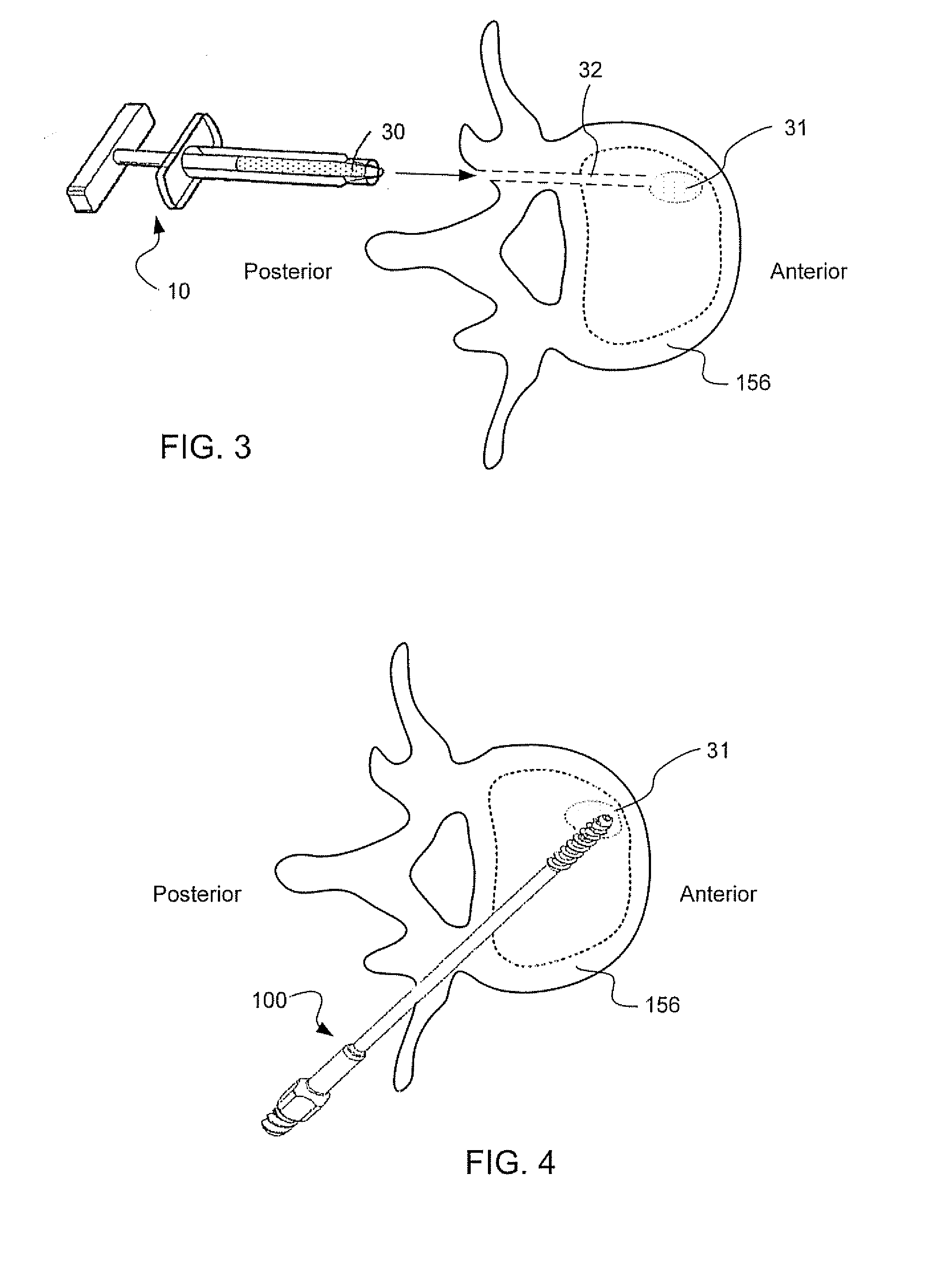 Injectable copolymer hydrogel useful for repairing vertebral compression fractures