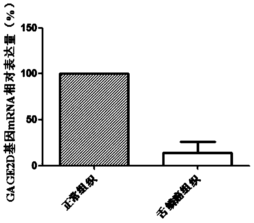 Gene markers for diagnosis and treatment of tongue squamous cell carcinoma