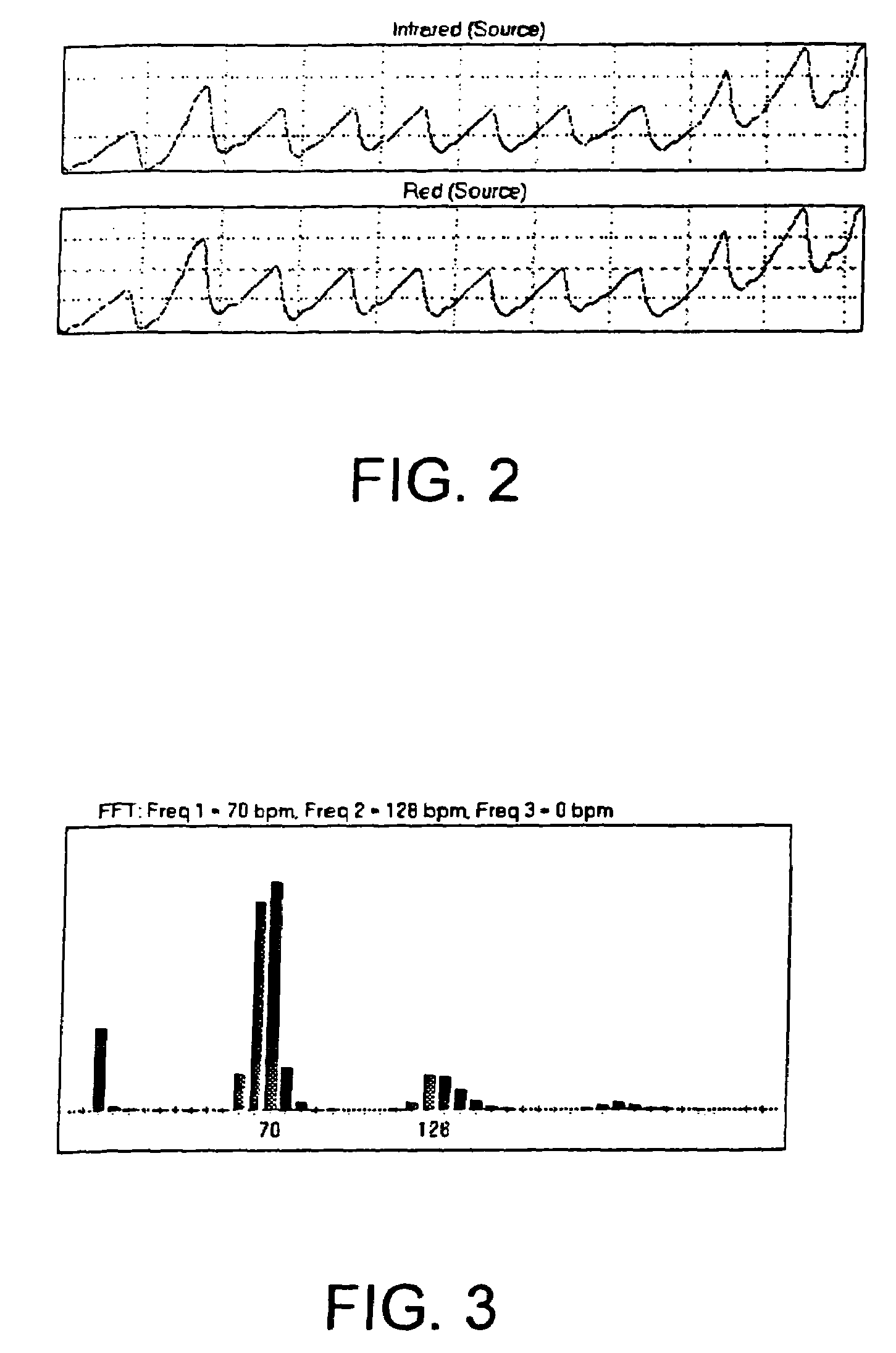 Method, apparatus and system for removing motion artifacts from measurements of bodily parameters