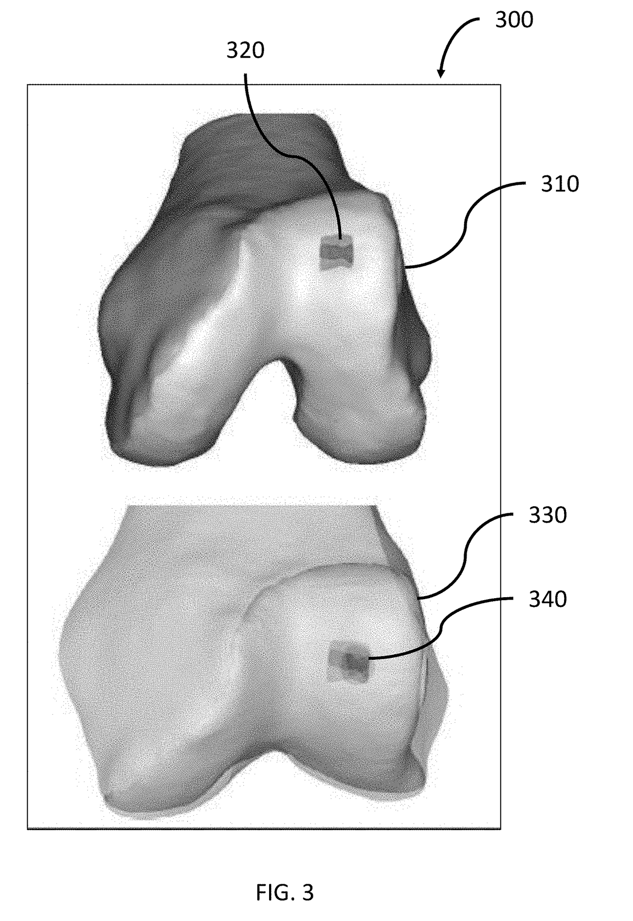 System and method for creating a decision support material indicating damage to an anatomical joint