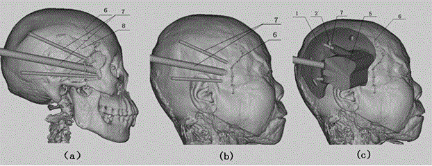 Percutaneous infratemporal fossa-orbit outer wall endoscope puncture guide plate and application method thereof