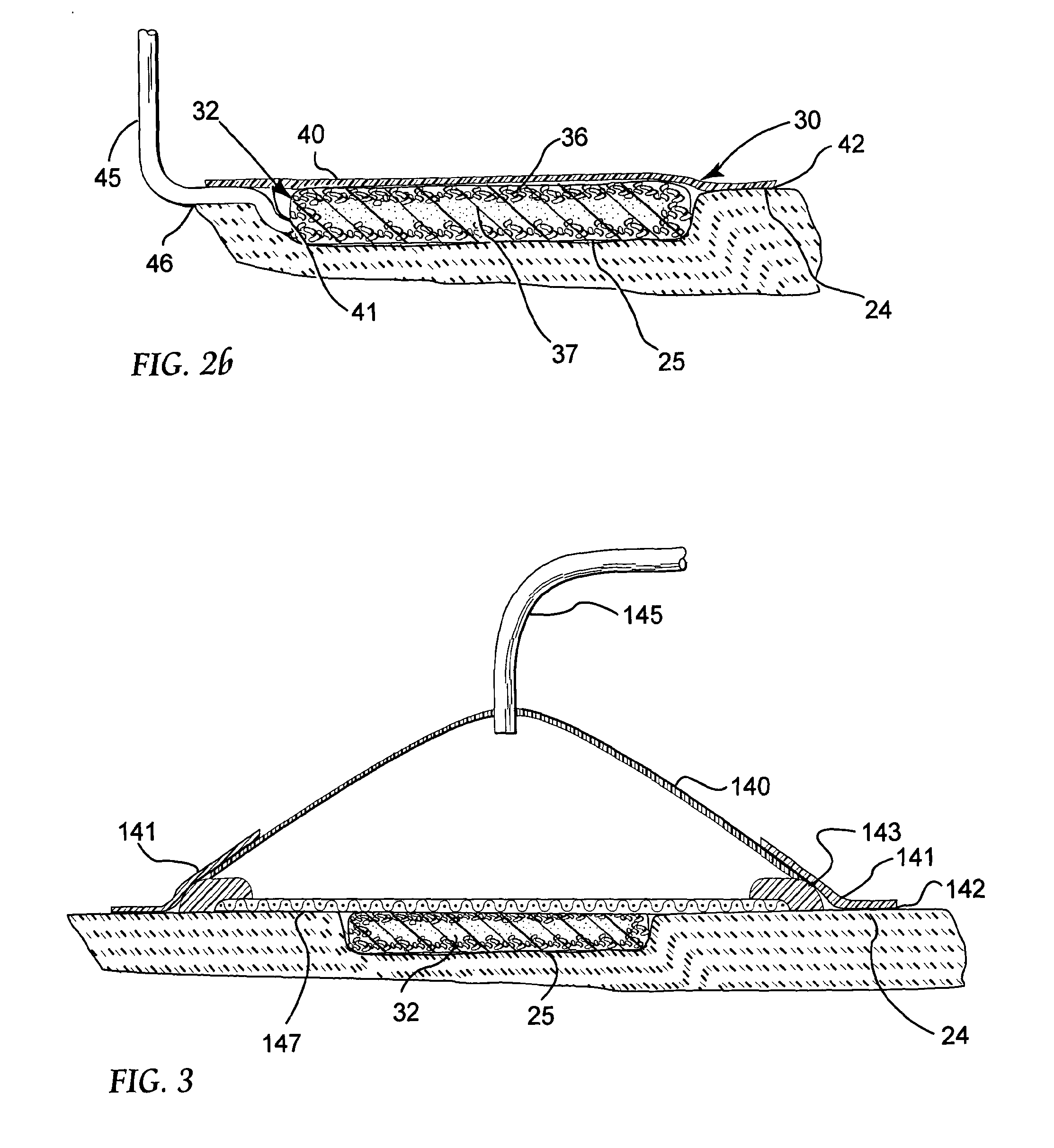 Reduced pressure treatment system