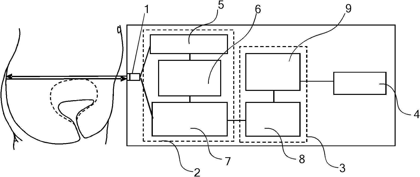 A-mode ultrasound based urination monitoring and alarming device and method