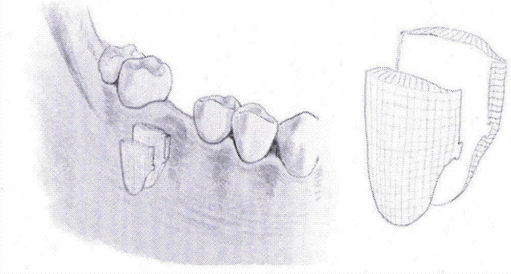 3D printing personalized cage-like tooth bone grafting guide plate