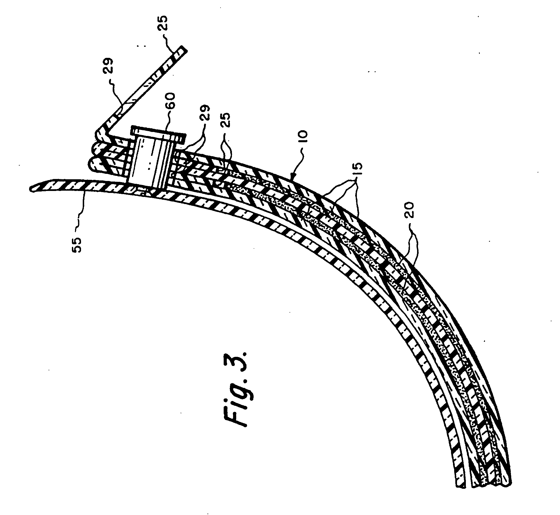 Optical stack of laminated removable lenses