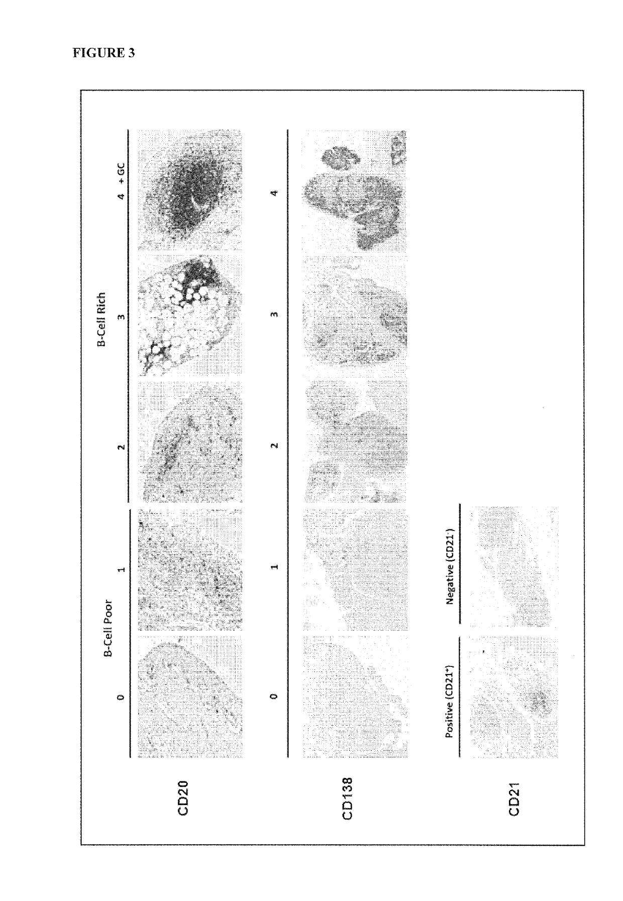 Method for treating rheumatoid arthritis