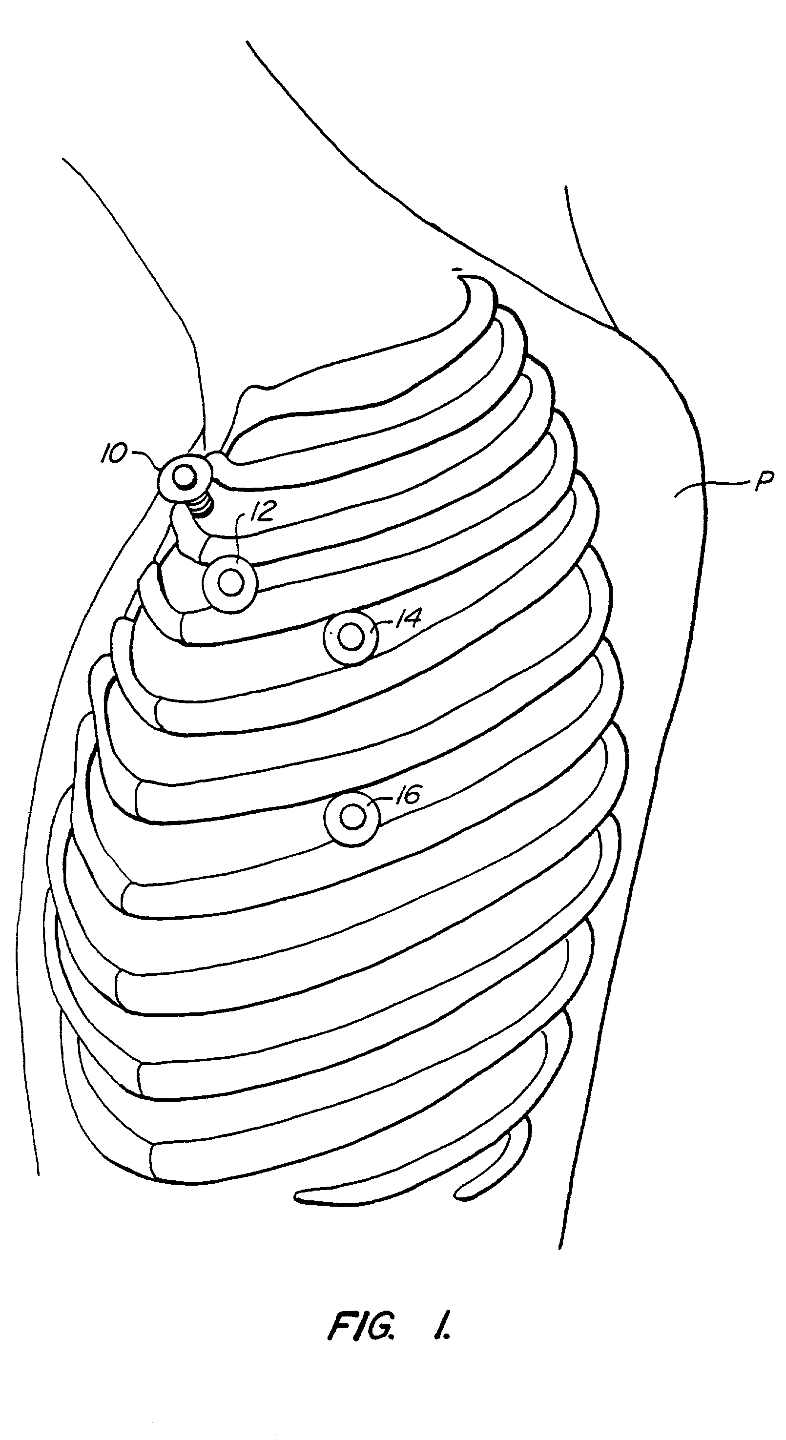 Methods and systems for performing thoracoscopic cardiac bypass and other procedures