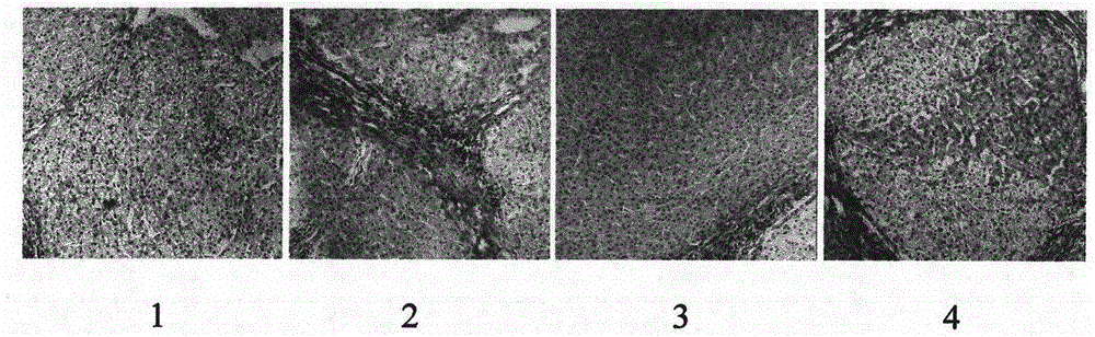 Pharmaceutical composition for preventing liver cirrhosis and its application