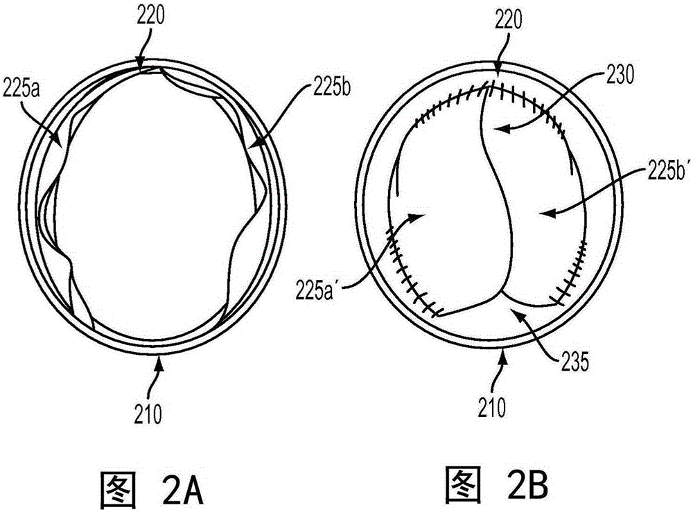 Expandable implantable conduit